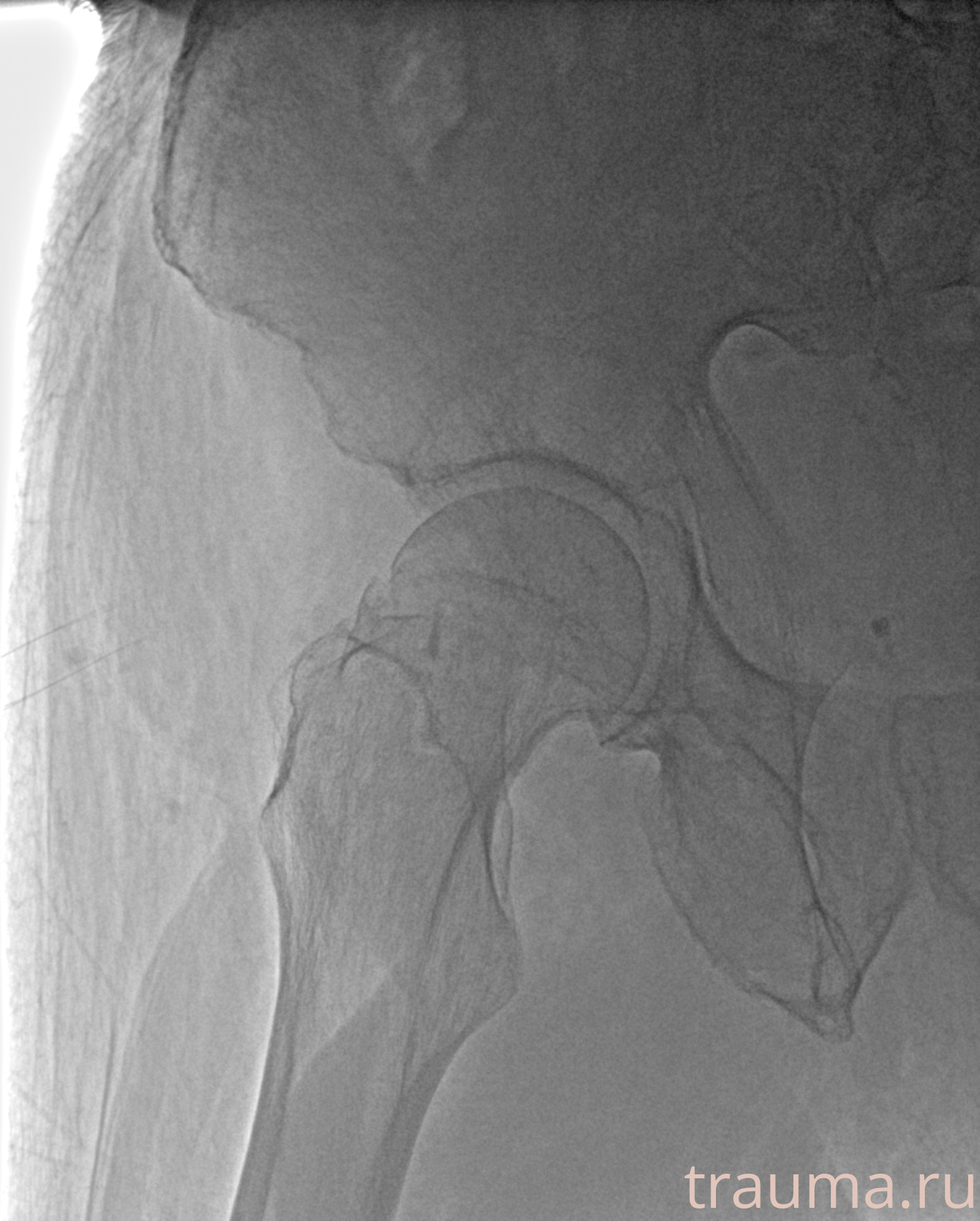 Рентген на дому: по вашему адресу приезжает врач-рентгенолог, травматолог-ортопед с мобильным рентгеновским аппаратом, проводит диагностику травмы или заболевания, делает необходимые рентгенограммы, дает рекомендации по дальнейшему лечению. Получить качественные снимки в домашних условиях возможно благодаря уникальной методике, разработанной МосРентген Центром для института  Склифосовского