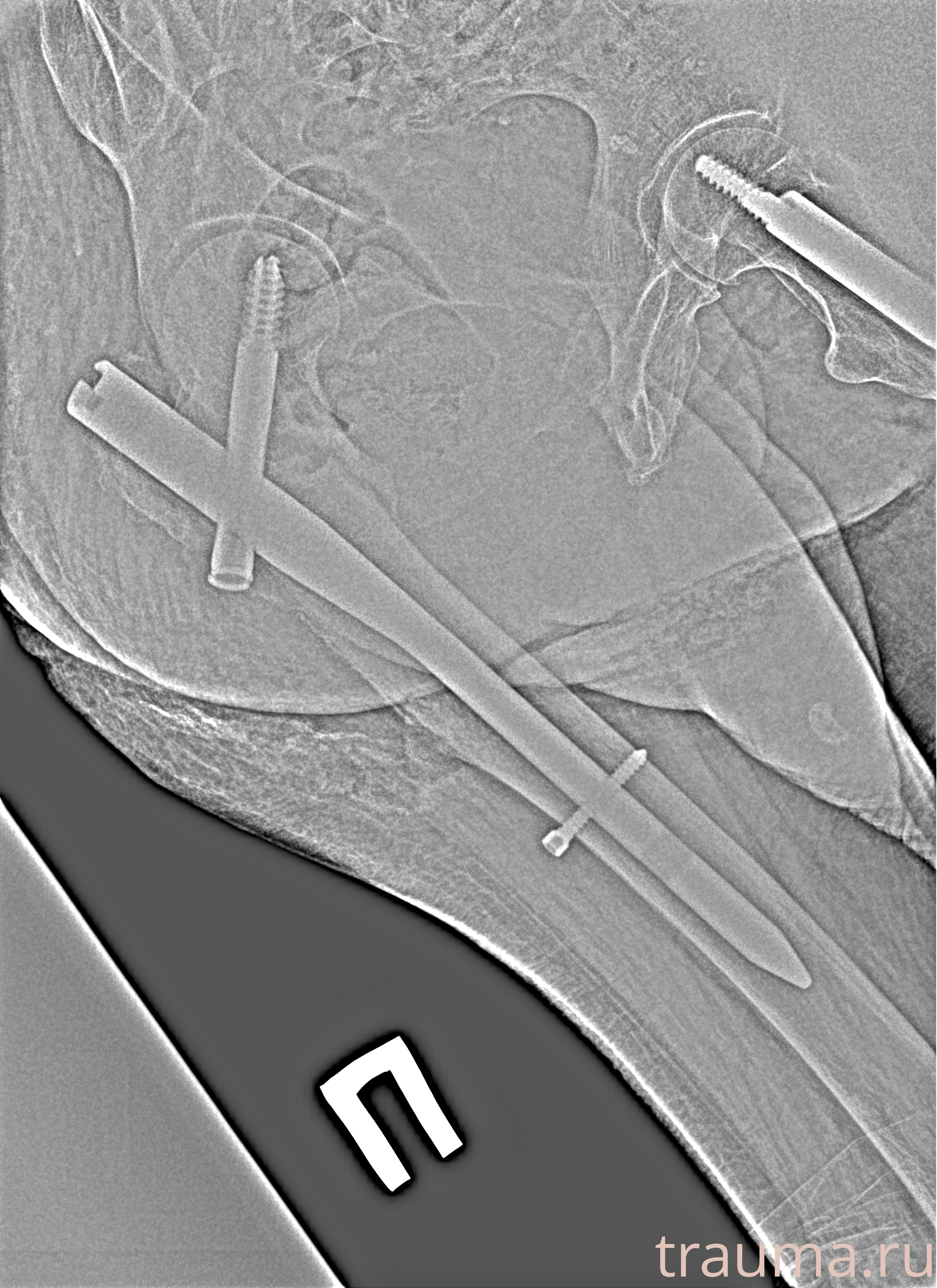 Рентген на дому: по вашему адресу приезжает врач-рентгенолог, травматолог-ортопед с мобильным рентгеновским аппаратом, проводит диагностику травмы или заболевания, делает необходимые рентгенограммы, дает рекомендации по дальнейшему лечению. Получить качественные снимки в домашних условиях возможно благодаря уникальной методике, разработанной МосРентген Центром для института  Склифосовского