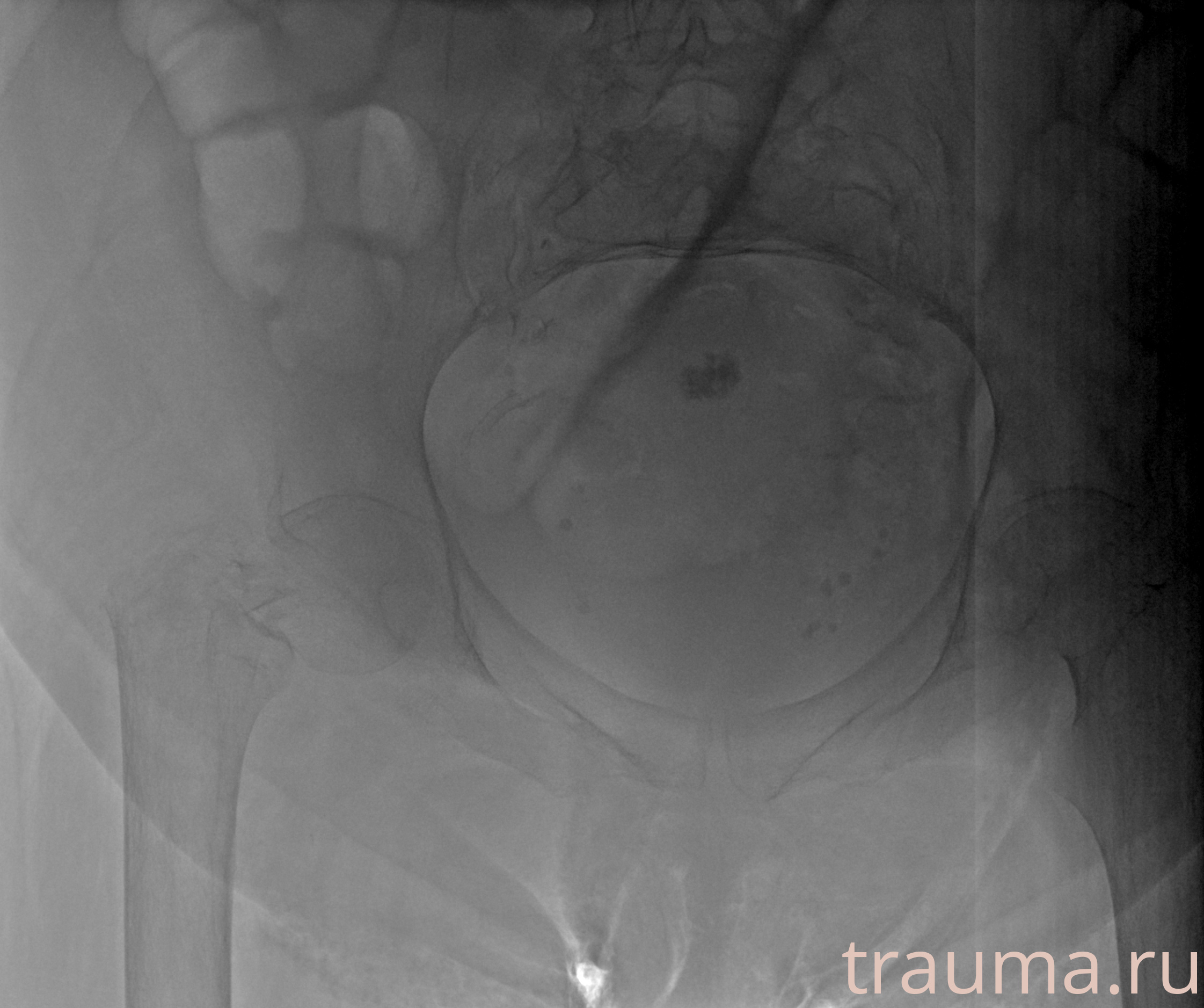 Рентген на дому: по вашему адресу приезжает врач-рентгенолог, травматолог-ортопед с мобильным рентгеновским аппаратом, проводит диагностику травмы или заболевания, делает необходимые рентгенограммы, дает рекомендации по дальнейшему лечению. Получить качественные снимки в домашних условиях возможно благодаря уникальной методике, разработанной МосРентген Центром для института  Склифосовского