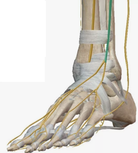 Эффективность метода Bridle при хирургическом лечении пациентов с синдромом «висящей стопы», вызванным нейропатией малоберцового нерва