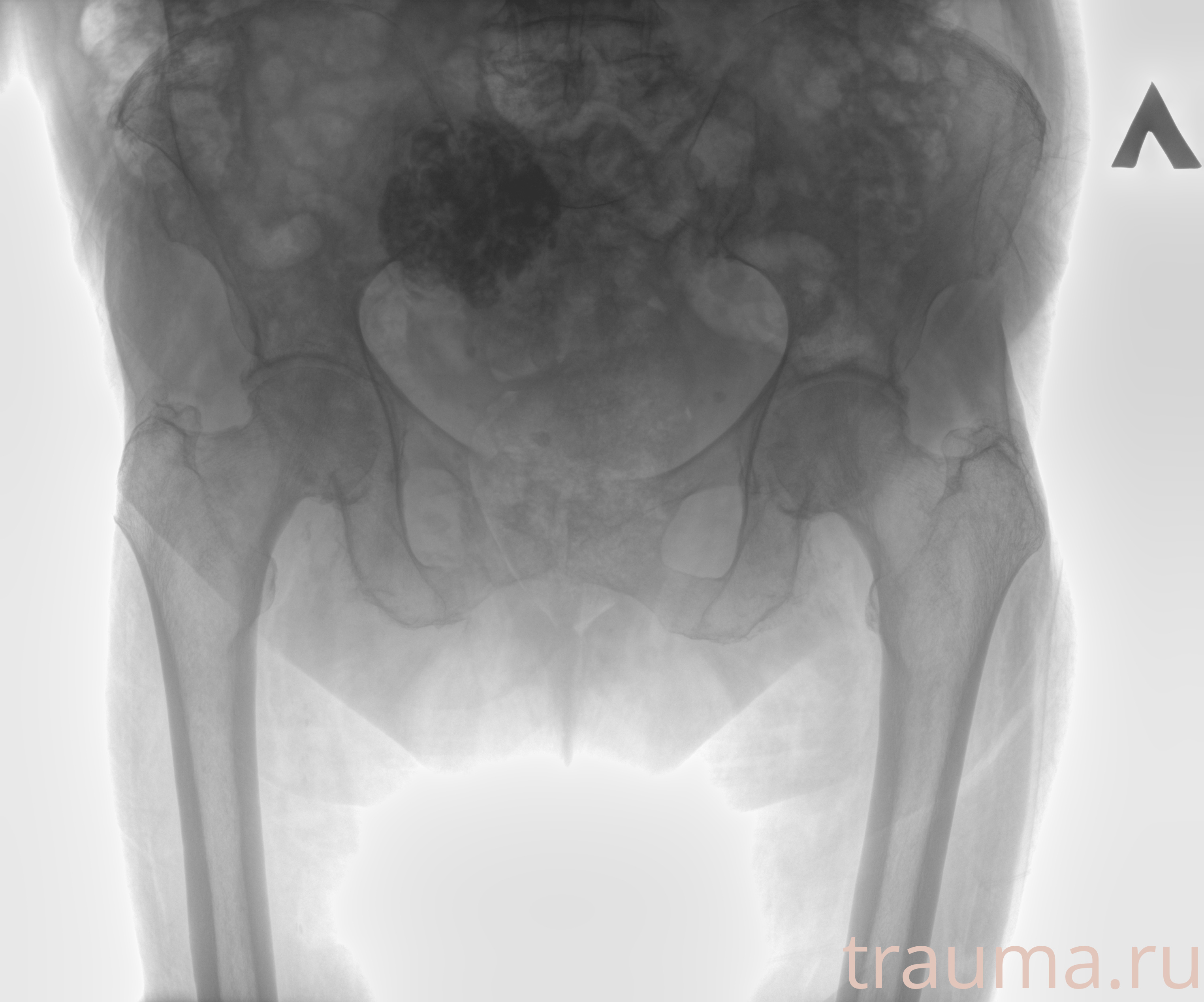 Рентген на дому: по вашему адресу приезжает врач-рентгенолог, травматолог-ортопед с мобильным рентгеновским аппаратом, проводит диагностику травмы или заболевания, делает необходимые рентгенограммы, дает рекомендации по дальнейшему лечению. Получить качественные снимки в домашних условиях возможно благодаря уникальной методике, разработанной МосРентген Центром для института  Склифосовского