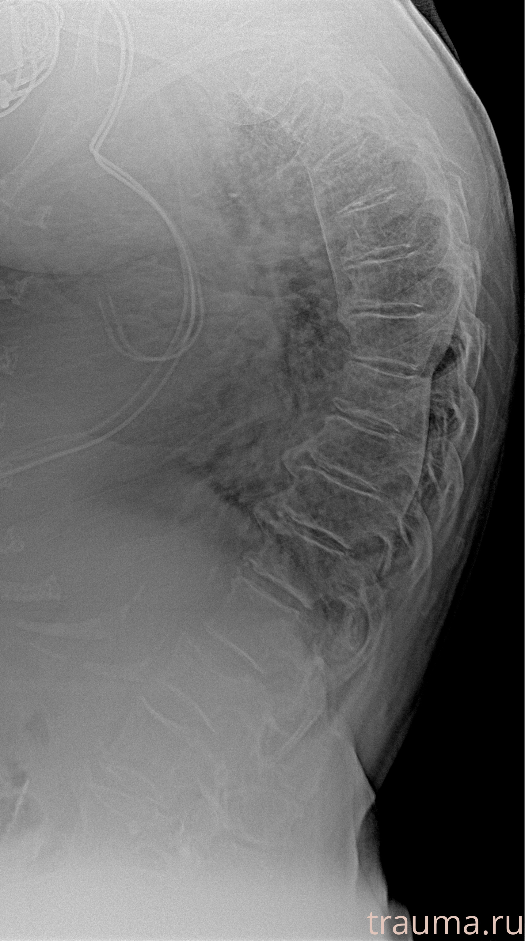 Рентген на дому: по вашему адресу приезжает врач-рентгенолог, травматолог-ортопед с мобильным рентгеновским аппаратом, проводит диагностику травмы или заболевания, делает необходимые рентгенограммы, дает рекомендации по дальнейшему лечению. Получить качественные снимки в домашних условиях возможно благодаря уникальной методике, разработанной МосРентген Центром для института  Склифосовского