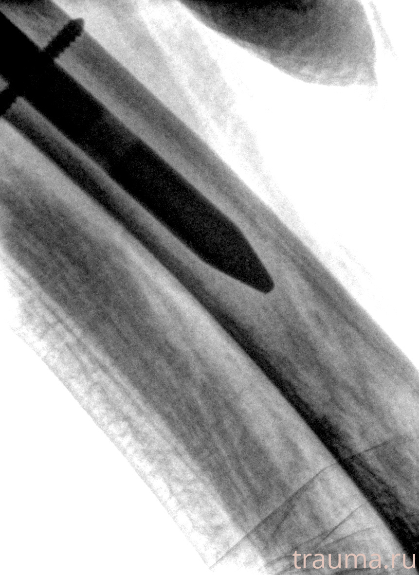 Рентген на дому: по вашему адресу приезжает врач-рентгенолог, травматолог-ортопед с мобильным рентгеновским аппаратом, проводит диагностику травмы или заболевания, делает необходимые рентгенограммы, дает рекомендации по дальнейшему лечению. Получить качественные снимки в домашних условиях возможно благодаря уникальной методике, разработанной МосРентген Центром для института  Склифосовского