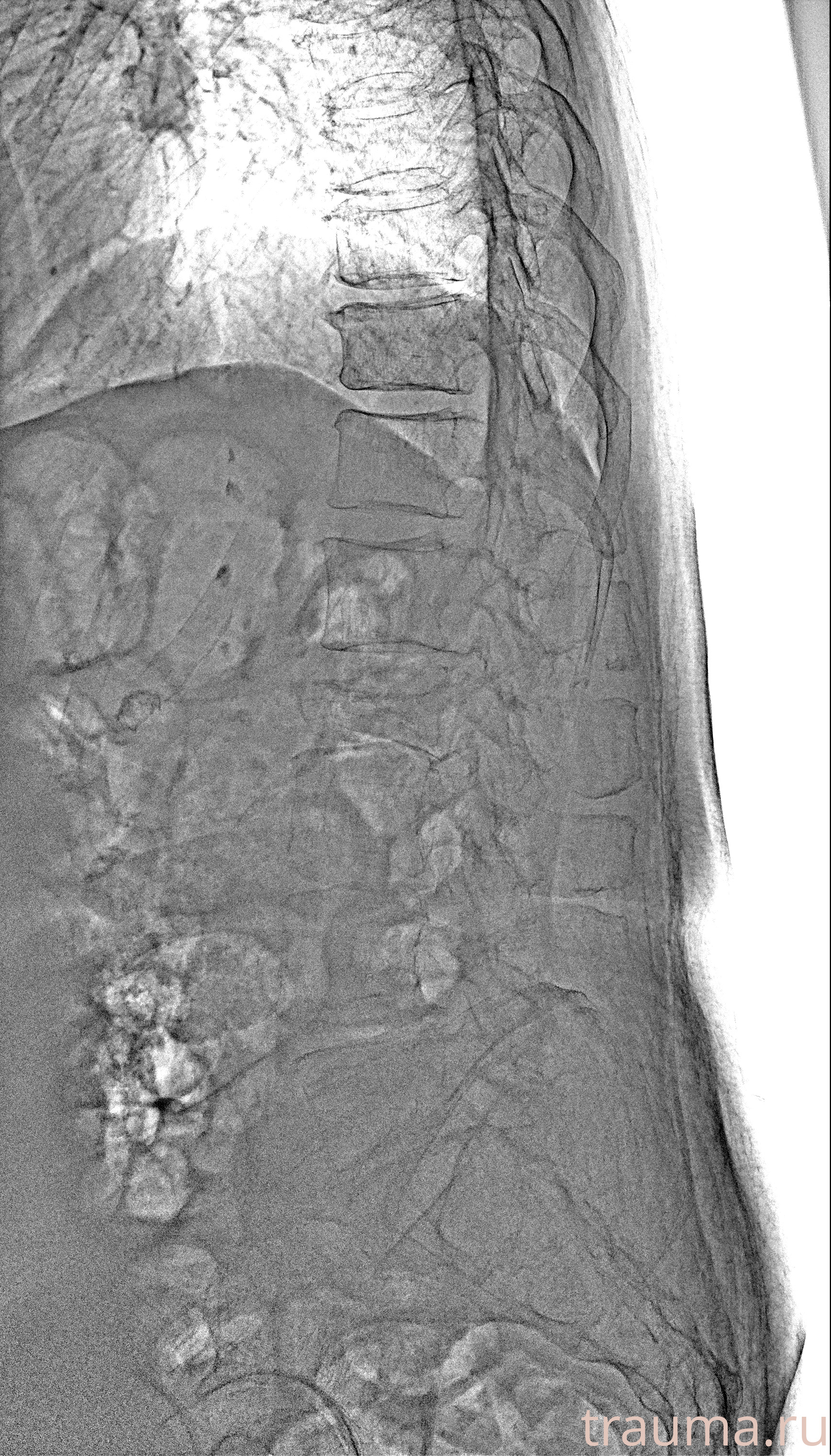 Рентген на дому: по вашему адресу приезжает врач-рентгенолог, травматолог-ортопед с мобильным рентгеновским аппаратом, проводит диагностику травмы или заболевания, делает необходимые рентгенограммы, дает рекомендации по дальнейшему лечению. Получить качественные снимки в домашних условиях возможно благодаря уникальной методике, разработанной МосРентген Центром для института  Склифосовского