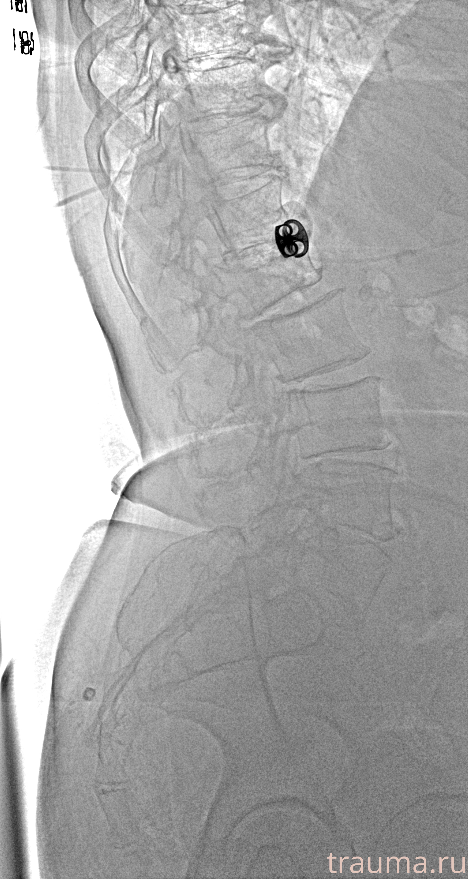 Рентген на дому: по вашему адресу приезжает врач-рентгенолог, травматолог-ортопед с мобильным рентгеновским аппаратом, проводит диагностику травмы или заболевания, делает необходимые рентгенограммы, дает рекомендации по дальнейшему лечению. Получить качественные снимки в домашних условиях возможно благодаря уникальной методике, разработанной МосРентген Центром для института  Склифосовского
