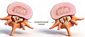 Минимально инвазивный эндоскопический метод лечения: дегенеративный стеноз поясничного отдела позвоночник