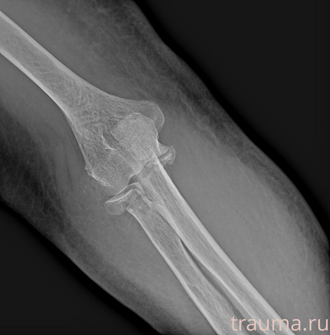 Рентген на дому: по вашему адресу приезжает врач-рентгенолог, травматолог-ортопед с мобильным рентгеновским аппаратом, проводит диагностику травмы или заболевания, делает необходимые рентгенограммы, дает рекомендации по дальнейшему лечению. Получить качественные снимки в домашних условиях возможно благодаря уникальной методике, разработанной МосРентген Центром для института  Склифосовского