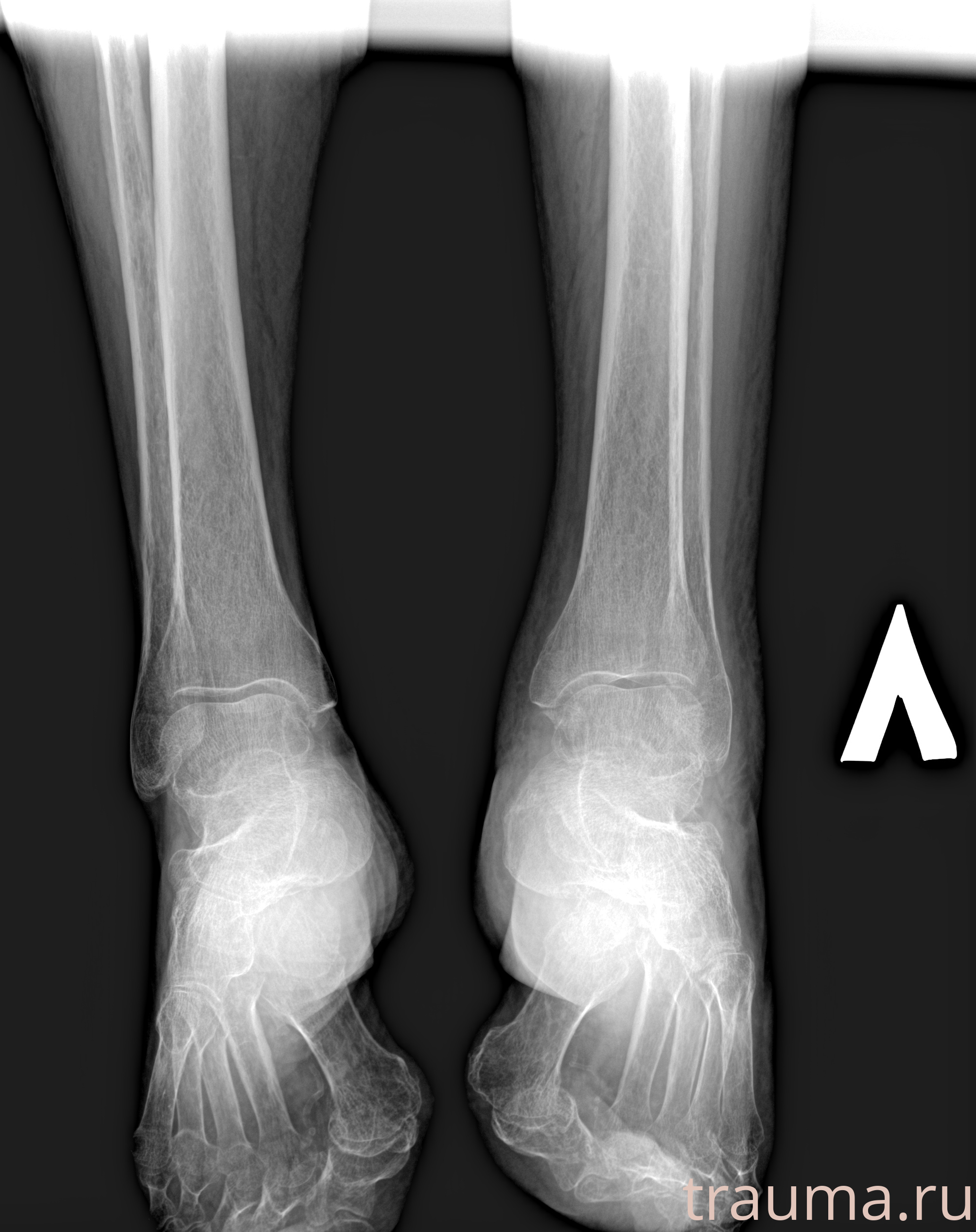 Рентген на дому: по вашему адресу приезжает врач-рентгенолог, травматолог-ортопед с мобильным рентгеновским аппаратом, проводит диагностику травмы или заболевания, делает необходимые рентгенограммы, дает рекомендации по дальнейшему лечению. Получить качественные снимки в домашних условиях возможно благодаря уникальной методике, разработанной МосРентген Центром для института  Склифосовского