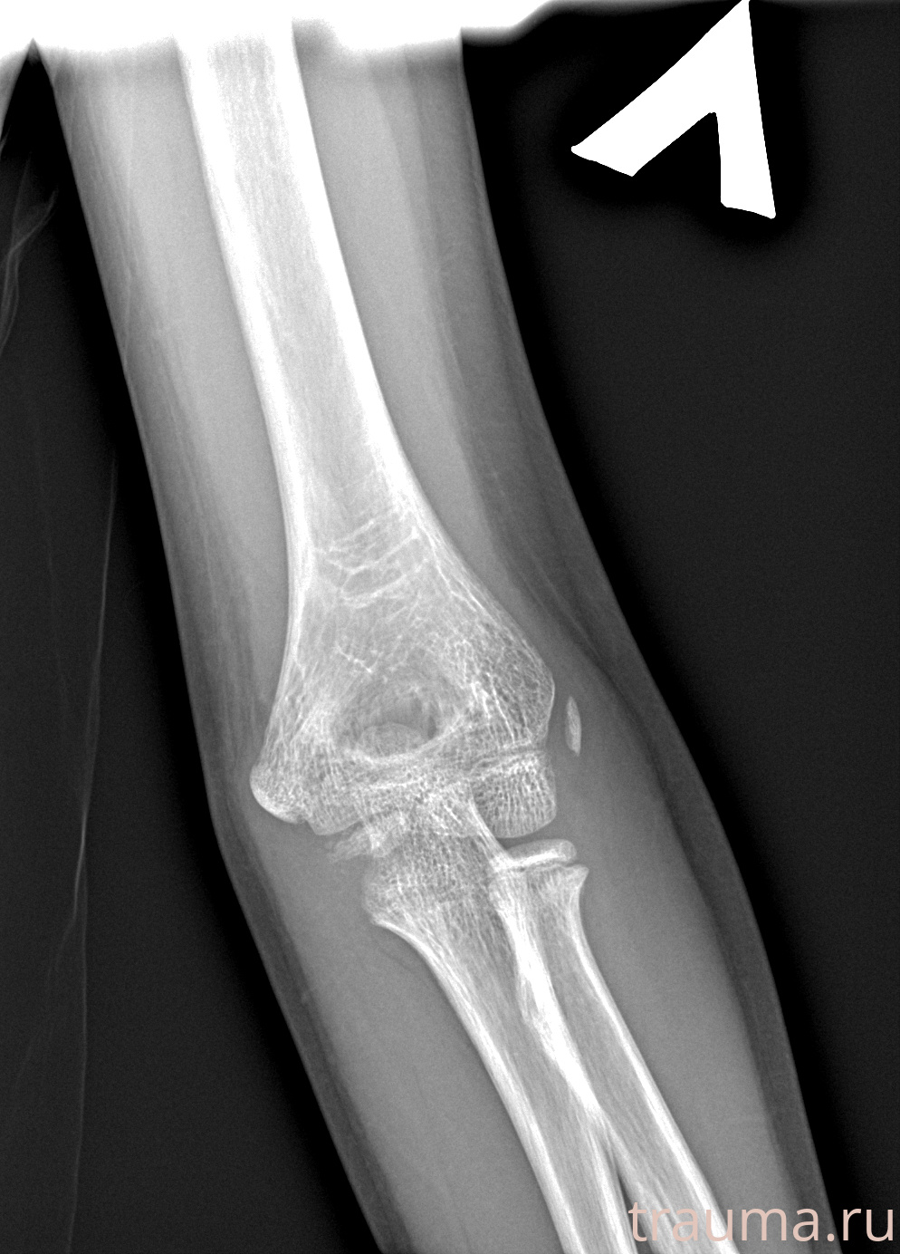 Рентген на дому: по вашему адресу приезжает врач-рентгенолог, травматолог-ортопед с мобильным рентгеновским аппаратом, проводит диагностику травмы или заболевания, делает необходимые рентгенограммы, дает рекомендации по дальнейшему лечению. Получить качественные снимки в домашних условиях возможно благодаря уникальной методике, разработанной МосРентген Центром для института  Склифосовского