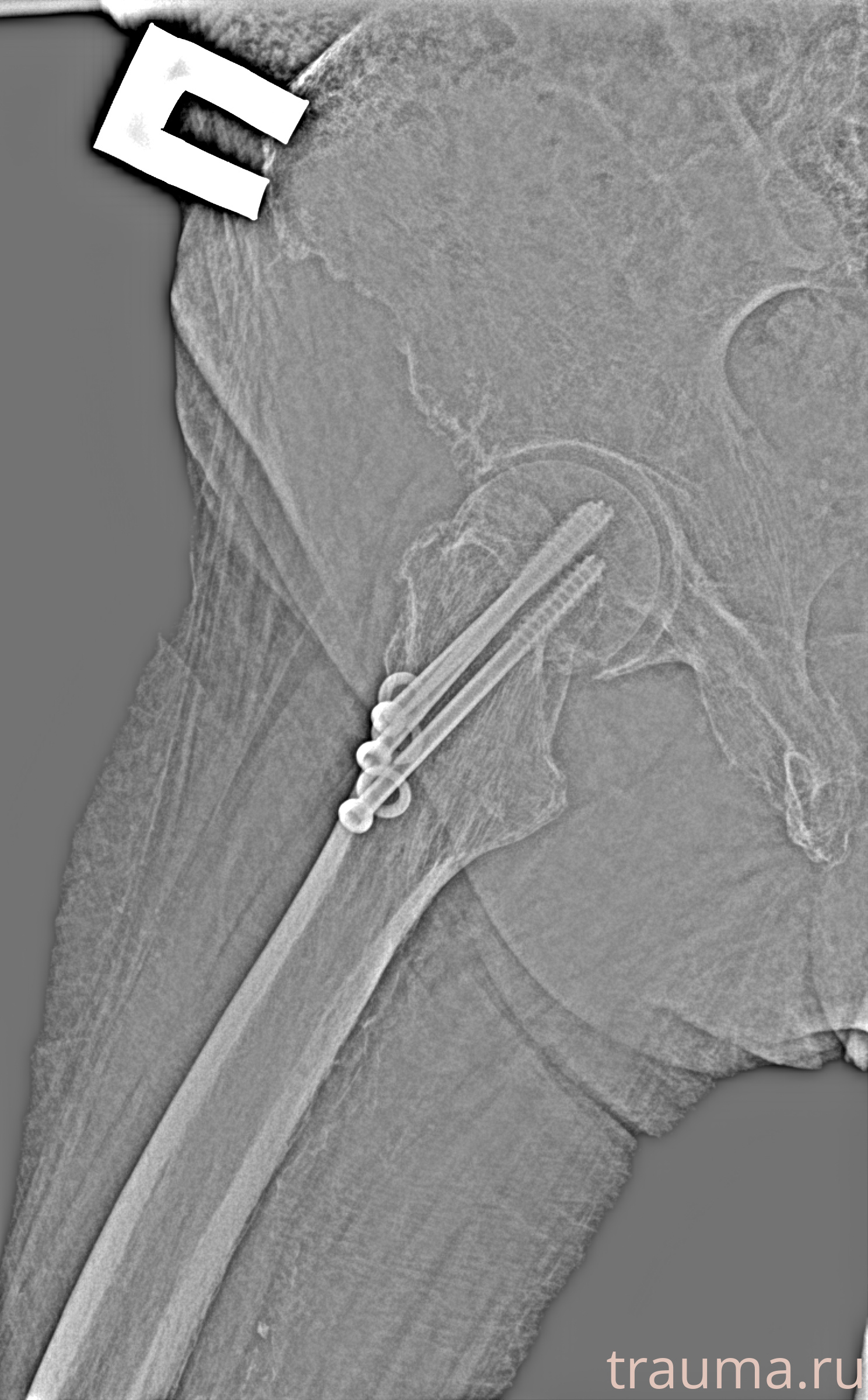 Рентген на дому: по вашему адресу приезжает врач-рентгенолог, травматолог-ортопед с мобильным рентгеновским аппаратом, проводит диагностику травмы или заболевания, делает необходимые рентгенограммы, дает рекомендации по дальнейшему лечению. Получить качественные снимки в домашних условиях возможно благодаря уникальной методике, разработанной МосРентген Центром для института  Склифосовского
