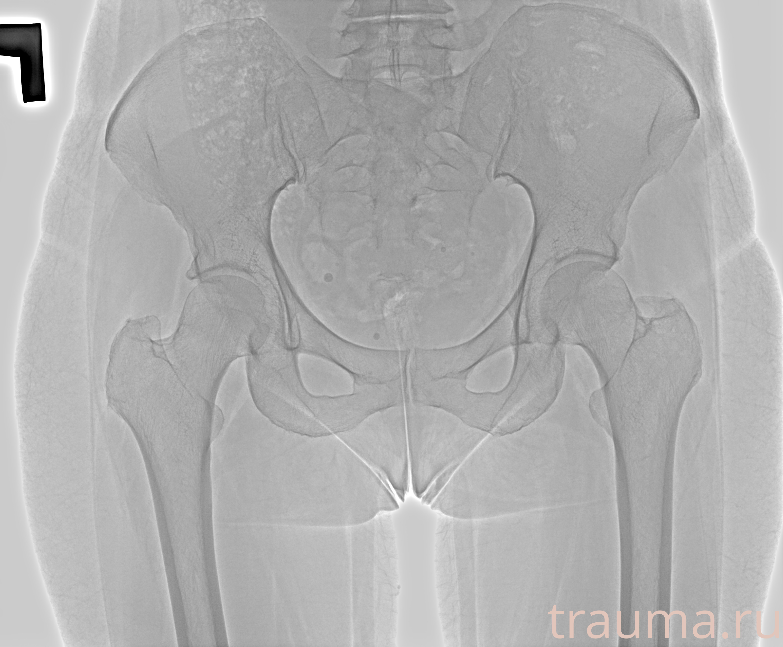 Рентген на дому: по вашему адресу приезжает врач-рентгенолог, травматолог-ортопед с мобильным рентгеновским аппаратом, проводит диагностику травмы или заболевания, делает необходимые рентгенограммы, дает рекомендации по дальнейшему лечению. Получить качественные снимки в домашних условиях возможно благодаря уникальной методике, разработанной МосРентген Центром для института  Склифосовского