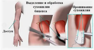 Опыт использования международной классификации функционирования при междисциплинарном подходе к лечению пациентов с повреждением дистального сухожилия двуглавой мышцы плеча Опыт использования международной классификации функционирования при междисциплинарном подходе к лечению пациентов с повреждением дистального сухожилия двуглавой мышцы плеча