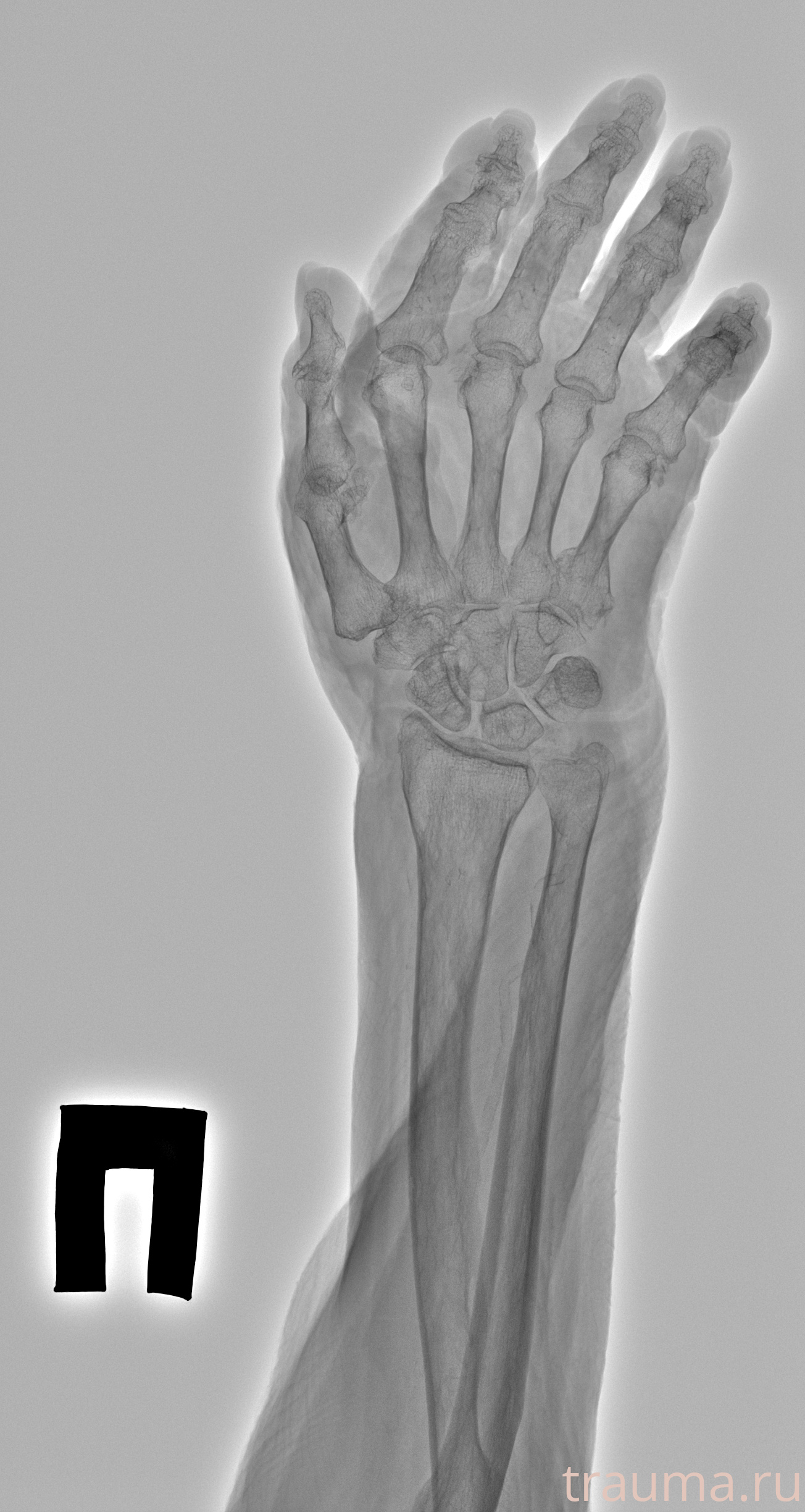 Рентген на дому: по вашему адресу приезжает врач-рентгенолог, травматолог-ортопед с мобильным рентгеновским аппаратом, проводит диагностику травмы или заболевания, делает необходимые рентгенограммы, дает рекомендации по дальнейшему лечению. Получить качественные снимки в домашних условиях возможно благодаря уникальной методике, разработанной МосРентген Центром для института  Склифосовского