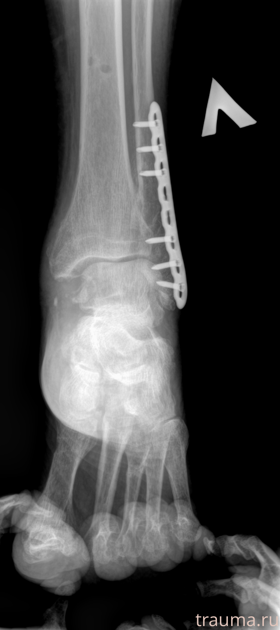 Рентген на дому: по вашему адресу приезжает врач-рентгенолог, травматолог-ортопед с мобильным рентгеновским аппаратом, проводит диагностику травмы или заболевания, делает необходимые рентгенограммы, дает рекомендации по дальнейшему лечению. Получить качественные снимки в домашних условиях возможно благодаря уникальной методике, разработанной МосРентген Центром для института  Склифосовского