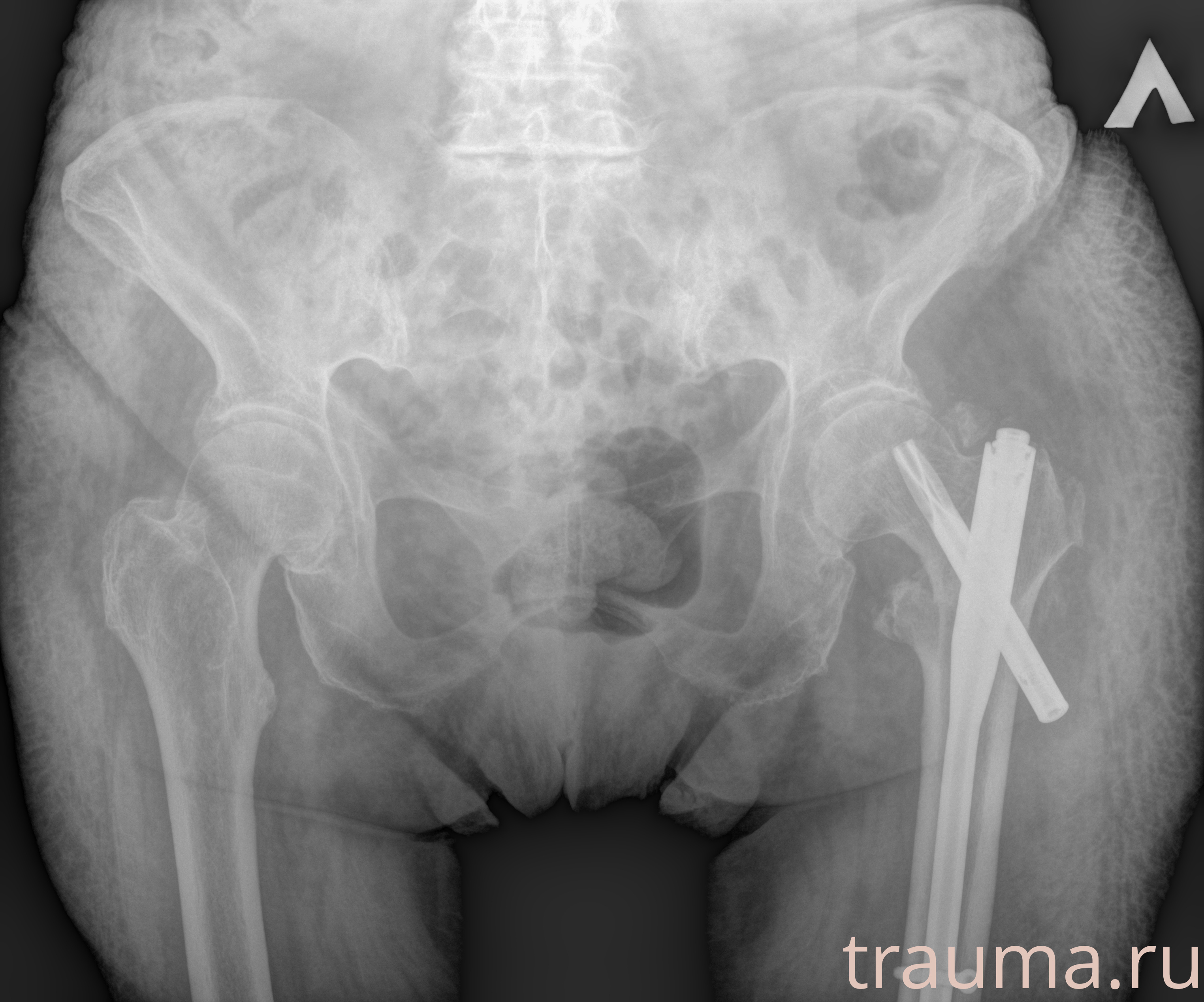 Рентген на дому: по вашему адресу приезжает врач-рентгенолог, травматолог-ортопед с мобильным рентгеновским аппаратом, проводит диагностику травмы или заболевания, делает необходимые рентгенограммы, дает рекомендации по дальнейшему лечению. Получить качественные снимки в домашних условиях возможно благодаря уникальной методике, разработанной МосРентген Центром для института  Склифосовского