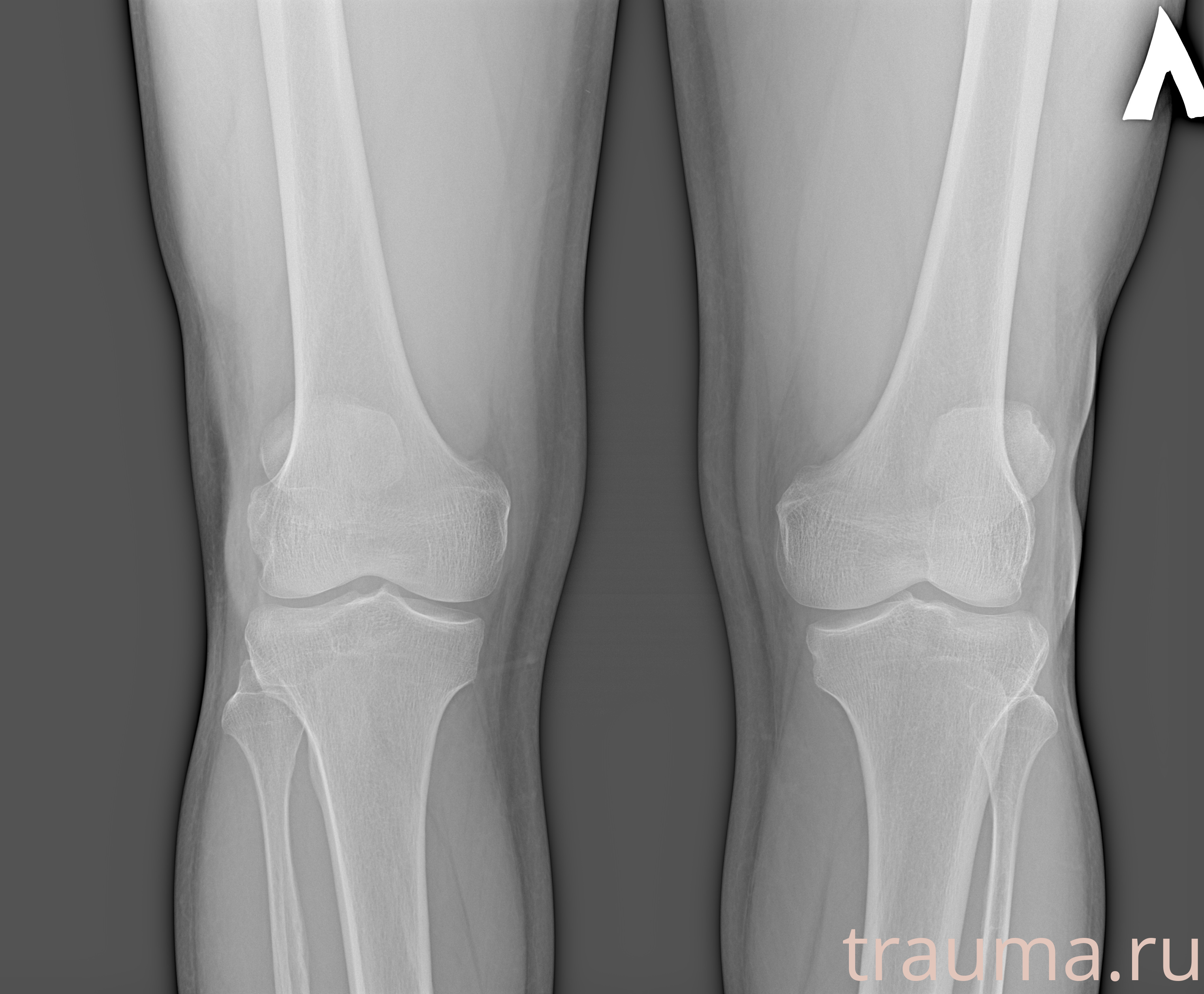 Рентген на дому: по вашему адресу приезжает врач-рентгенолог, травматолог-ортопед с мобильным рентгеновским аппаратом, проводит диагностику травмы или заболевания, делает необходимые рентгенограммы, дает рекомендации по дальнейшему лечению. Получить качественные снимки в домашних условиях возможно благодаря уникальной методике, разработанной МосРентген Центром для института  Склифосовского