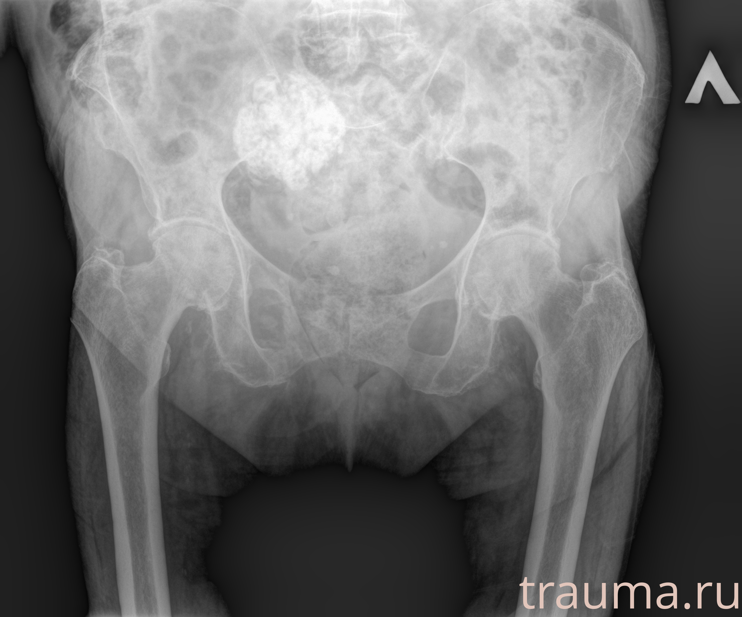 Рентген на дому: по вашему адресу приезжает врач-рентгенолог, травматолог-ортопед с мобильным рентгеновским аппаратом, проводит диагностику травмы или заболевания, делает необходимые рентгенограммы, дает рекомендации по дальнейшему лечению. Получить качественные снимки в домашних условиях возможно благодаря уникальной методике, разработанной МосРентген Центром для института  Склифосовского