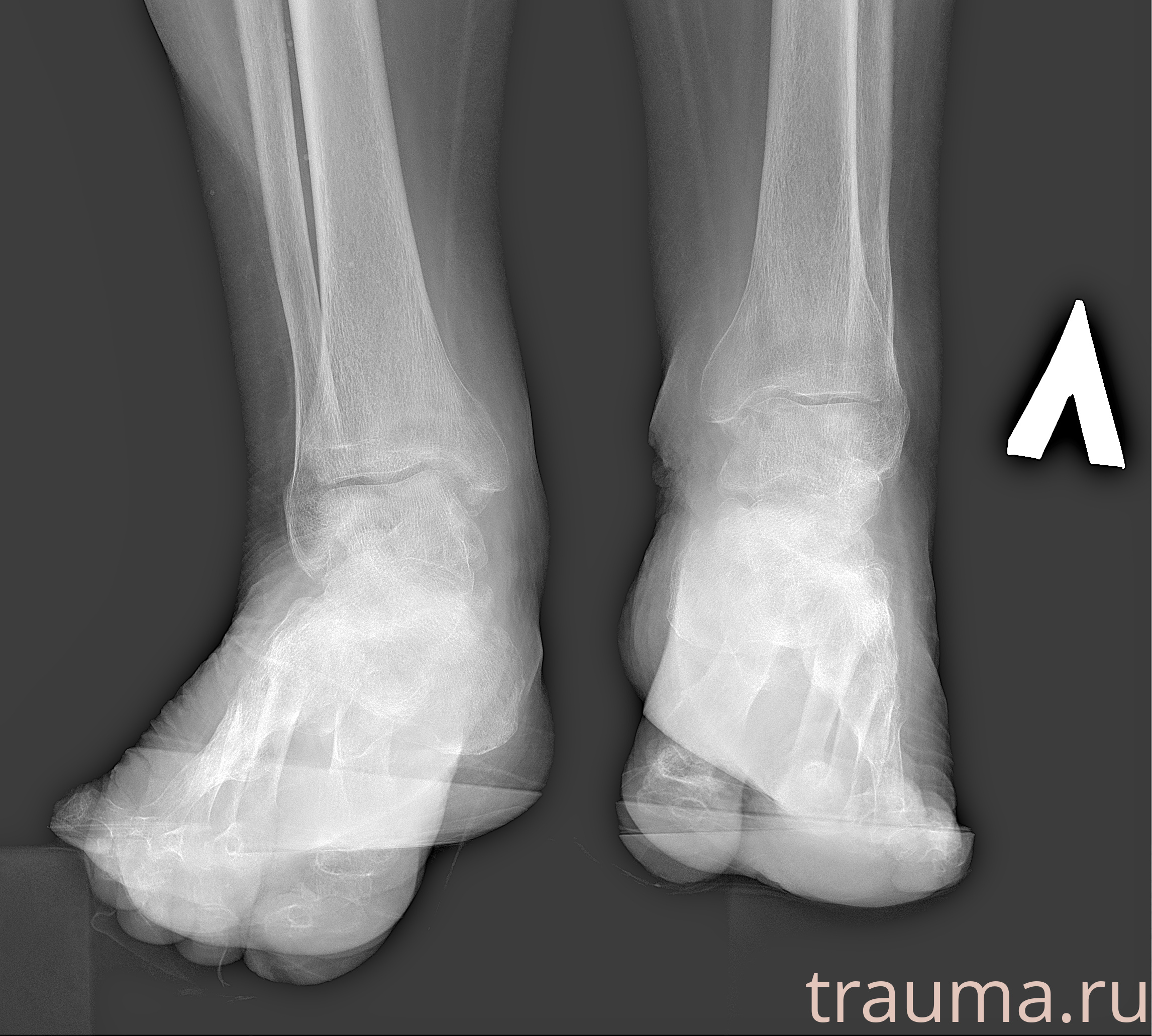 Рентген на дому: по вашему адресу приезжает врач-рентгенолог, травматолог-ортопед с мобильным рентгеновским аппаратом, проводит диагностику травмы или заболевания, делает необходимые рентгенограммы, дает рекомендации по дальнейшему лечению. Получить качественные снимки в домашних условиях возможно благодаря уникальной методике, разработанной МосРентген Центром для института  Склифосовского