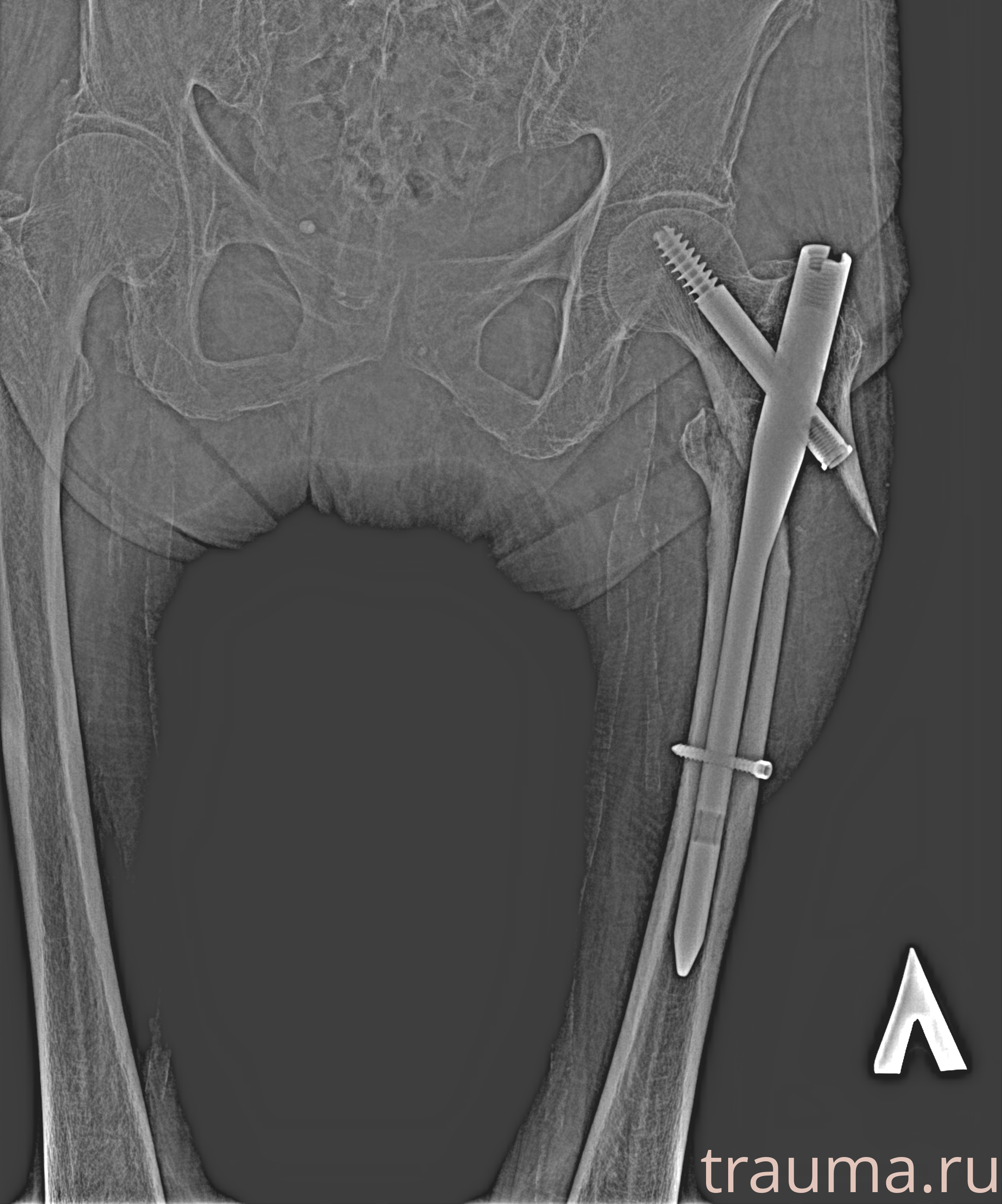 Рентген на дому: по вашему адресу приезжает врач-рентгенолог, травматолог-ортопед с мобильным рентгеновским аппаратом, проводит диагностику травмы или заболевания, делает необходимые рентгенограммы, дает рекомендации по дальнейшему лечению. Получить качественные снимки в домашних условиях возможно благодаря уникальной методике, разработанной МосРентген Центром для института  Склифосовского