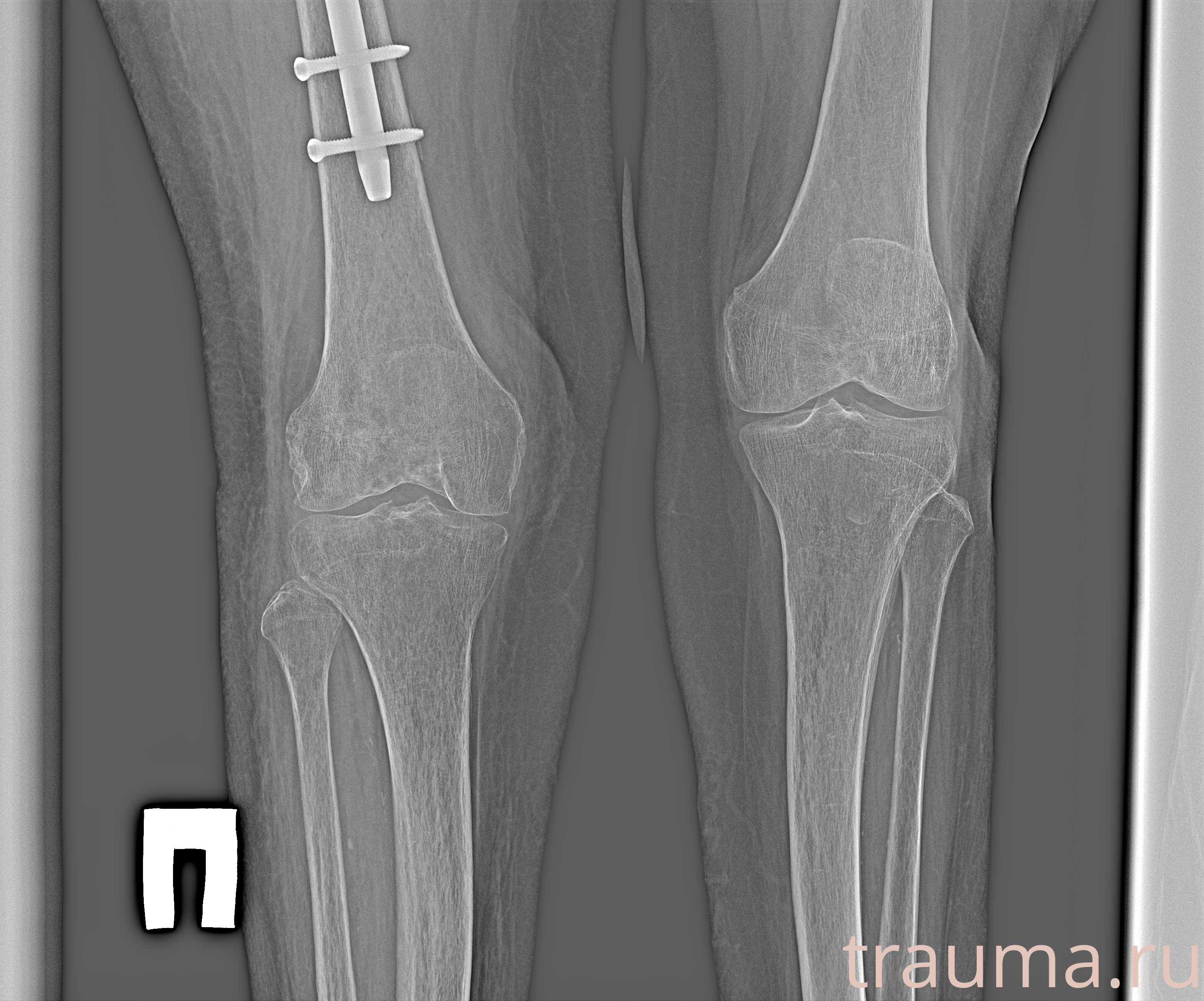 Рентген на дому: по вашему адресу приезжает врач-рентгенолог, травматолог-ортопед с мобильным рентгеновским аппаратом, проводит диагностику травмы или заболевания, делает необходимые рентгенограммы, дает рекомендации по дальнейшему лечению. Получить качественные снимки в домашних условиях возможно благодаря уникальной методике, разработанной МосРентген Центром для института  Склифосовского