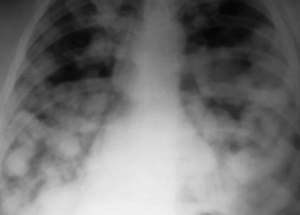 Трудности диагностики метастатического поражения легких
