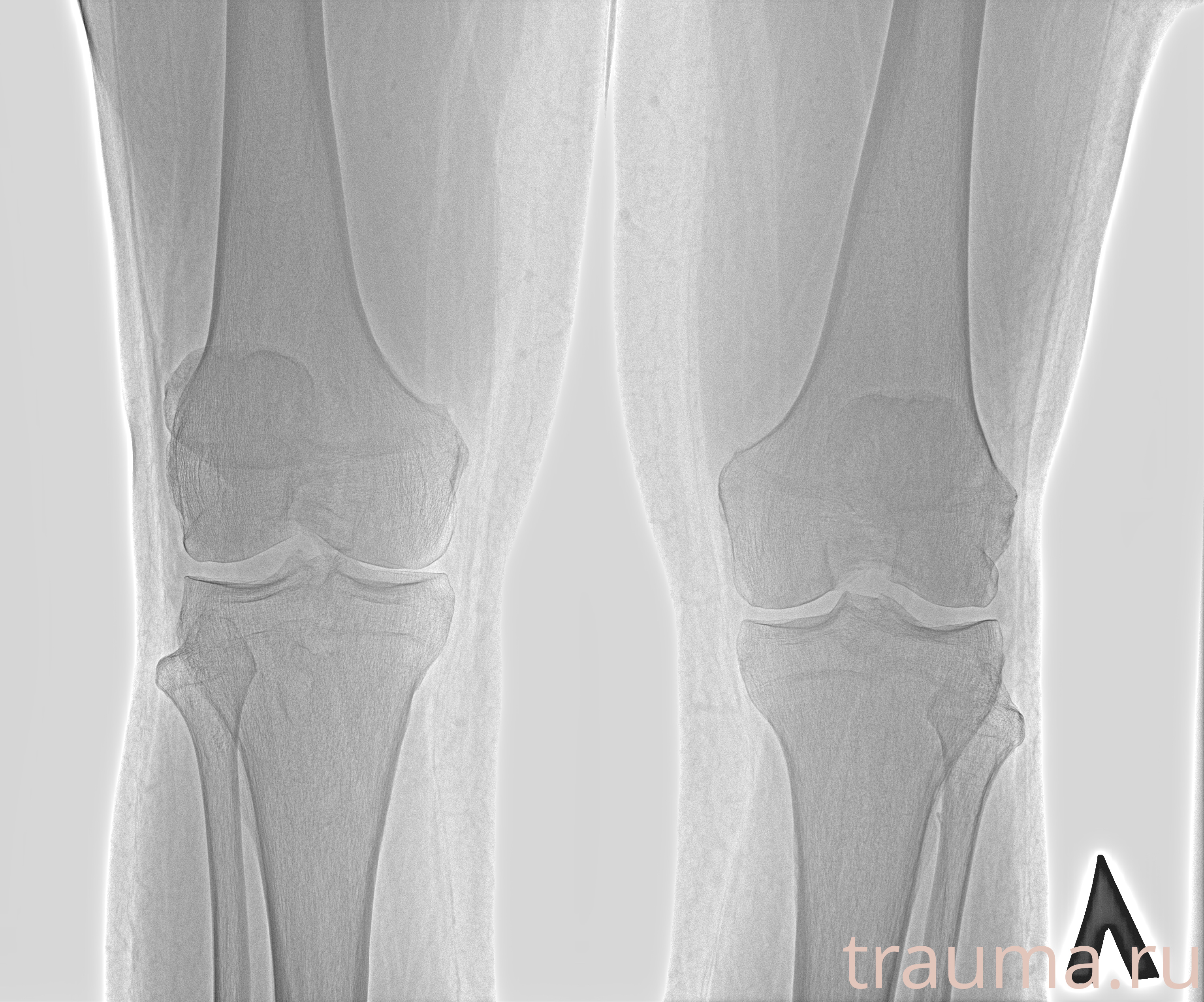 Рентген на дому: по вашему адресу приезжает врач-рентгенолог, травматолог-ортопед с мобильным рентгеновским аппаратом, проводит диагностику травмы или заболевания, делает необходимые рентгенограммы, дает рекомендации по дальнейшему лечению. Получить качественные снимки в домашних условиях возможно благодаря уникальной методике, разработанной МосРентген Центром для института  Склифосовского