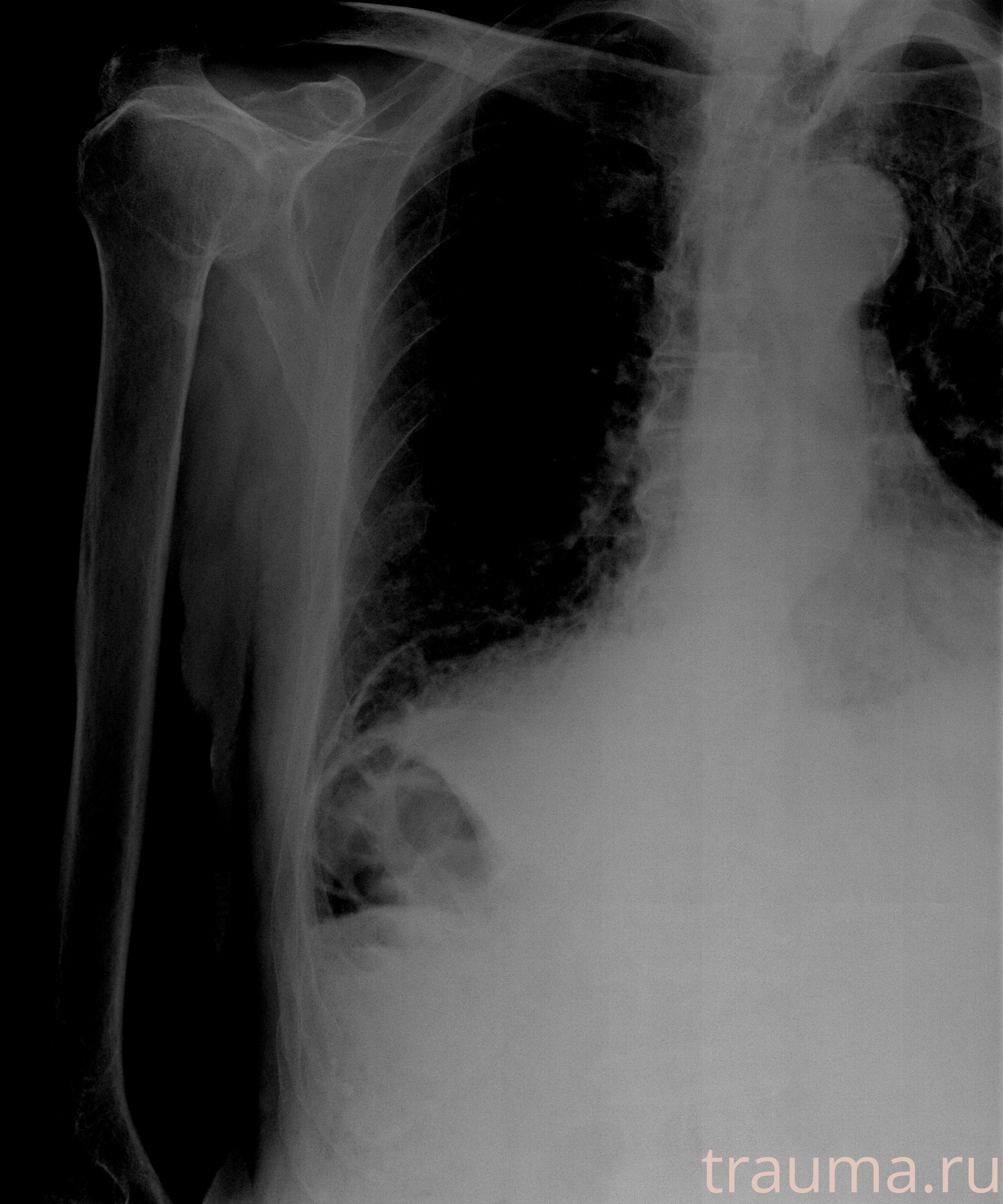 Рентген на дому: по вашему адресу приезжает врач-рентгенолог, травматолог-ортопед с мобильным рентгеновским аппаратом, проводит диагностику травмы или заболевания, делает необходимые рентгенограммы, дает рекомендации по дальнейшему лечению. Получить качественные снимки в домашних условиях возможно благодаря уникальной методике, разработанной МосРентген Центром для института  Склифосовского