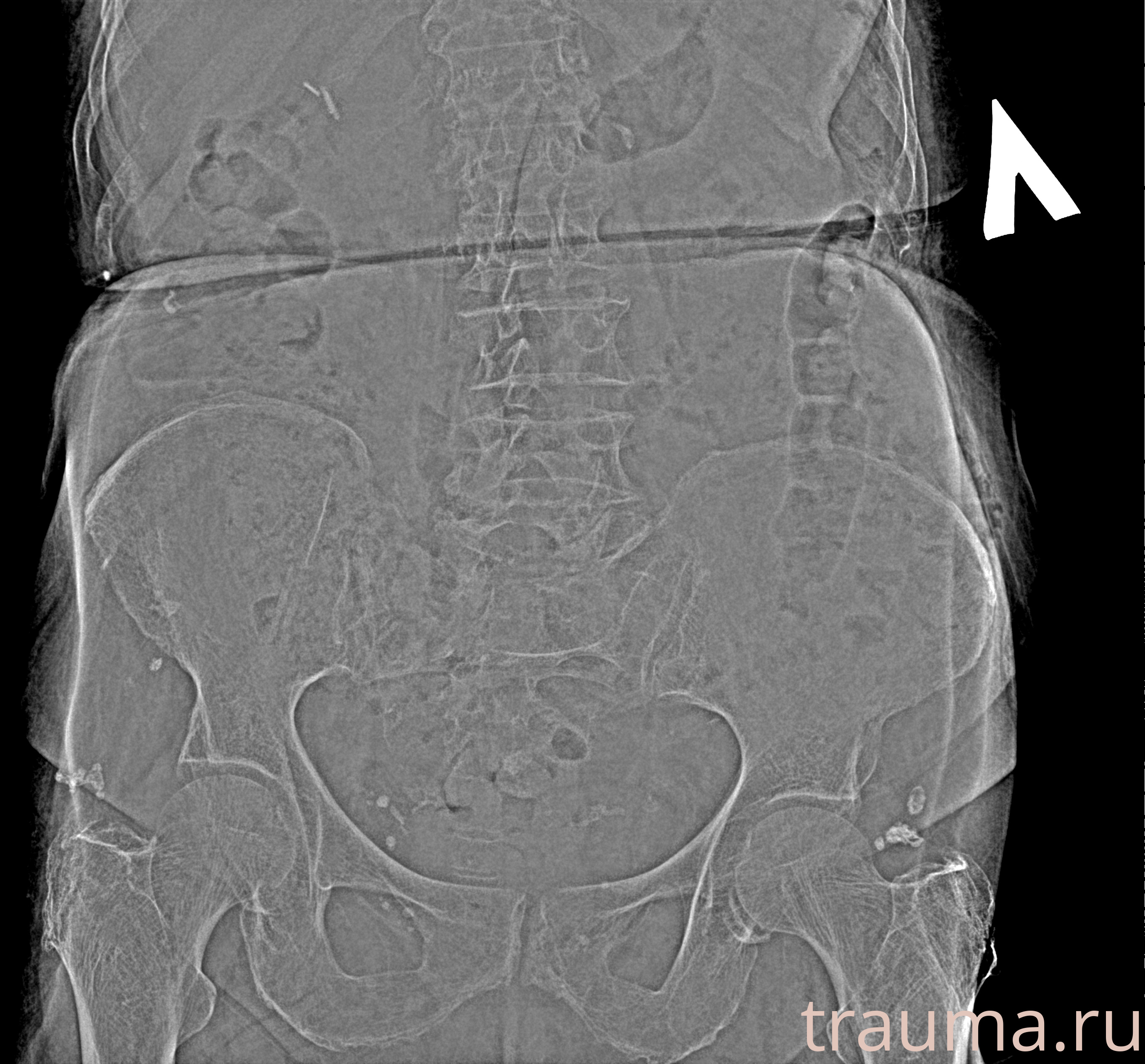 Рентген на дому: по вашему адресу приезжает врач-рентгенолог, травматолог-ортопед с мобильным рентгеновским аппаратом, проводит диагностику травмы или заболевания, делает необходимые рентгенограммы, дает рекомендации по дальнейшему лечению. Получить качественные снимки в домашних условиях возможно благодаря уникальной методике, разработанной МосРентген Центром для института  Склифосовского