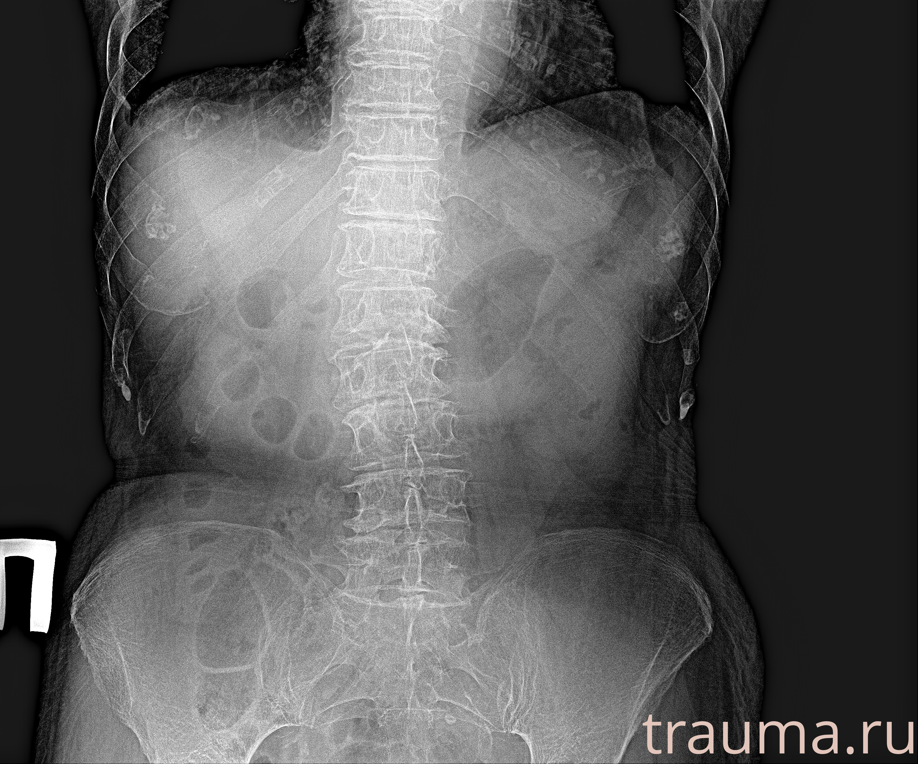Рентген на дому: по вашему адресу приезжает врач-рентгенолог, травматолог-ортопед с мобильным рентгеновским аппаратом, проводит диагностику травмы или заболевания, делает необходимые рентгенограммы, дает рекомендации по дальнейшему лечению. Получить качественные снимки в домашних условиях возможно благодаря уникальной методике, разработанной МосРентген Центром для института  Склифосовского