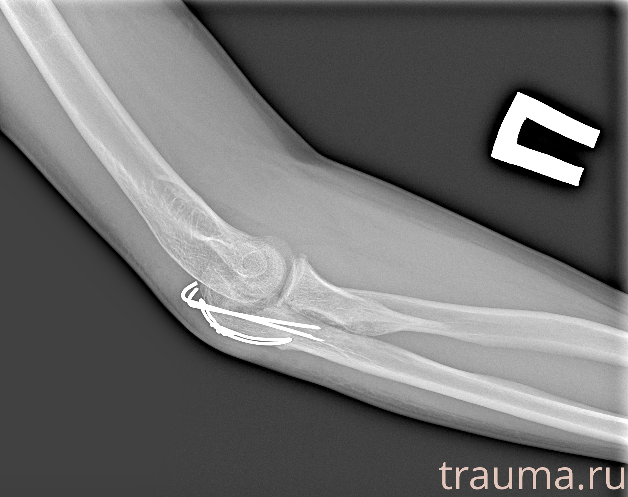 Рентген на дому: по вашему адресу приезжает врач-рентгенолог, травматолог-ортопед с мобильным рентгеновским аппаратом, проводит диагностику травмы или заболевания, делает необходимые рентгенограммы, дает рекомендации по дальнейшему лечению. Получить качественные снимки в домашних условиях возможно благодаря уникальной методике, разработанной МосРентген Центром для института  Склифосовского