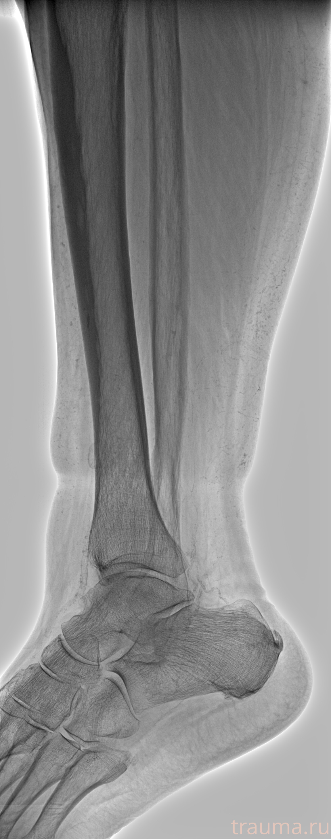 Рентген на дому: по вашему адресу приезжает врач-рентгенолог, травматолог-ортопед с мобильным рентгеновским аппаратом, проводит диагностику травмы или заболевания, делает необходимые рентгенограммы, дает рекомендации по дальнейшему лечению. Получить качественные снимки в домашних условиях возможно благодаря уникальной методике, разработанной МосРентген Центром для института  Склифосовского