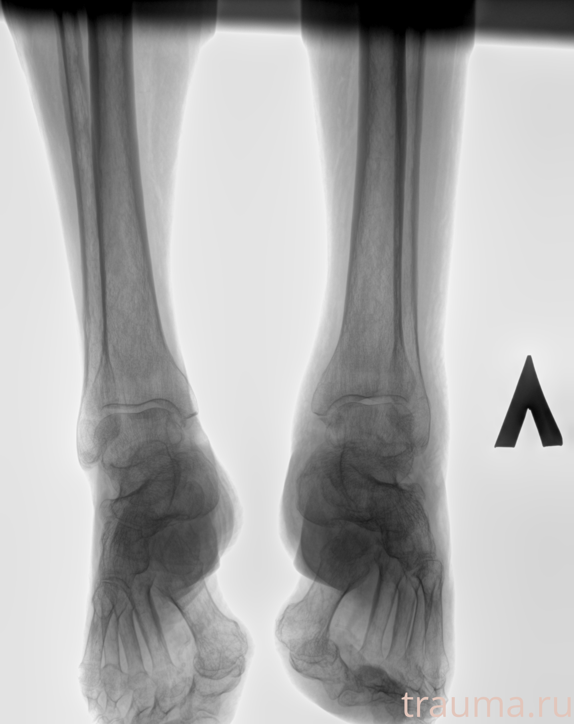 Рентген на дому: по вашему адресу приезжает врач-рентгенолог, травматолог-ортопед с мобильным рентгеновским аппаратом, проводит диагностику травмы или заболевания, делает необходимые рентгенограммы, дает рекомендации по дальнейшему лечению. Получить качественные снимки в домашних условиях возможно благодаря уникальной методике, разработанной МосРентген Центром для института  Склифосовского