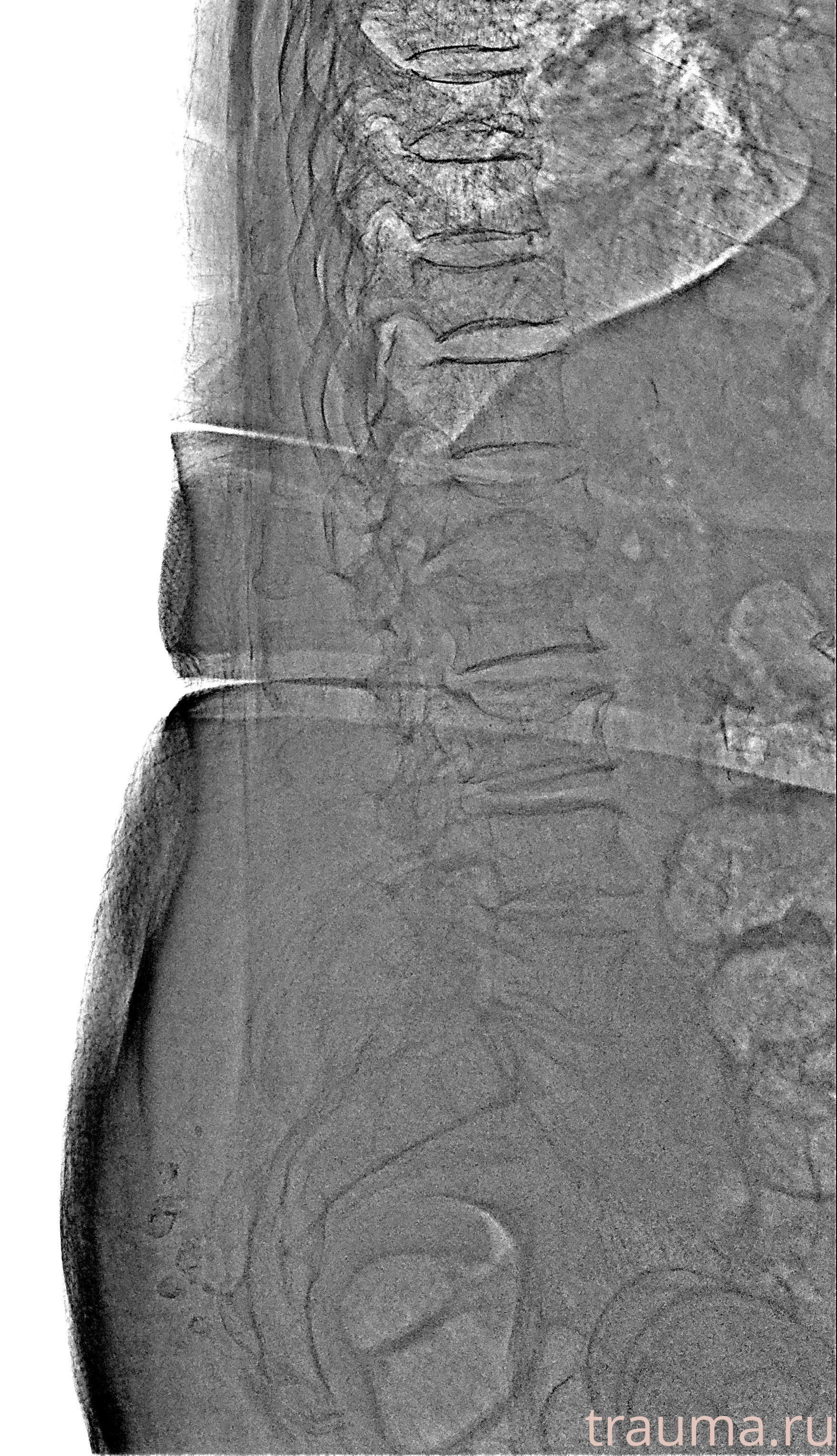 Рентген на дому: по вашему адресу приезжает врач-рентгенолог, травматолог-ортопед с мобильным рентгеновским аппаратом, проводит диагностику травмы или заболевания, делает необходимые рентгенограммы, дает рекомендации по дальнейшему лечению. Получить качественные снимки в домашних условиях возможно благодаря уникальной методике, разработанной МосРентген Центром для института  Склифосовского