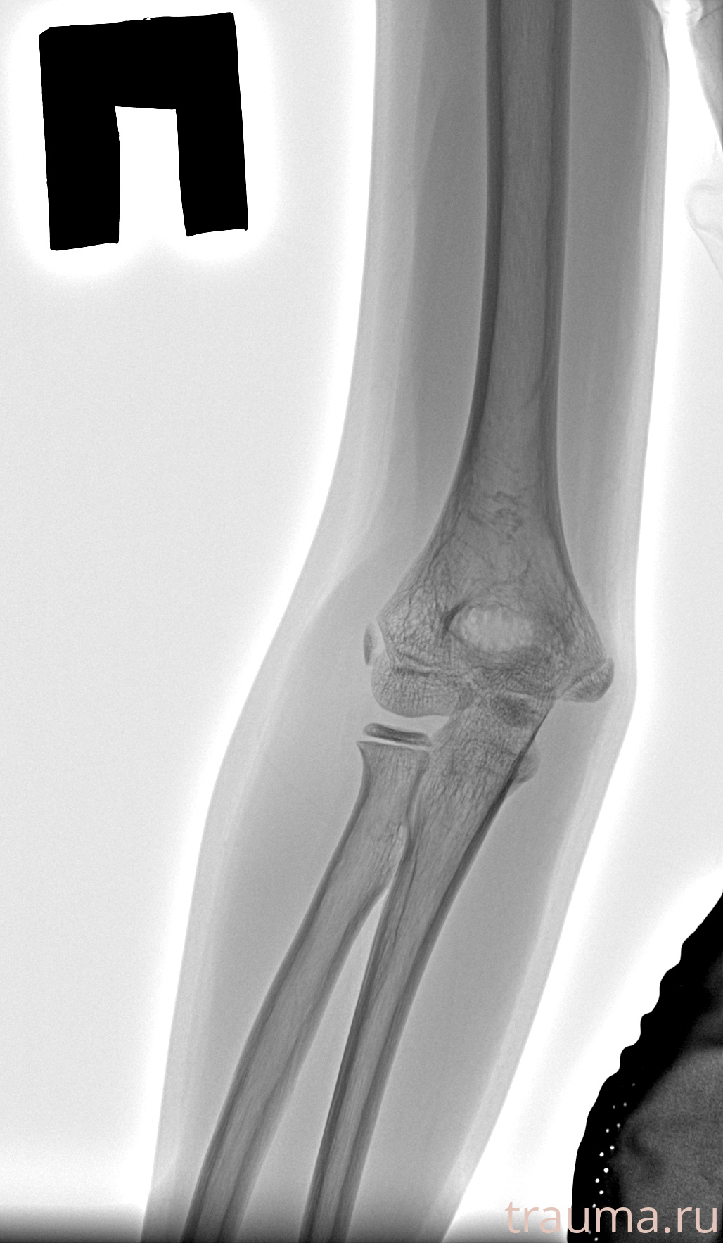 Рентген на дому: по вашему адресу приезжает врач-рентгенолог, травматолог-ортопед с мобильным рентгеновским аппаратом, проводит диагностику травмы или заболевания, делает необходимые рентгенограммы, дает рекомендации по дальнейшему лечению. Получить качественные снимки в домашних условиях возможно благодаря уникальной методике, разработанной МосРентген Центром для института  Склифосовского