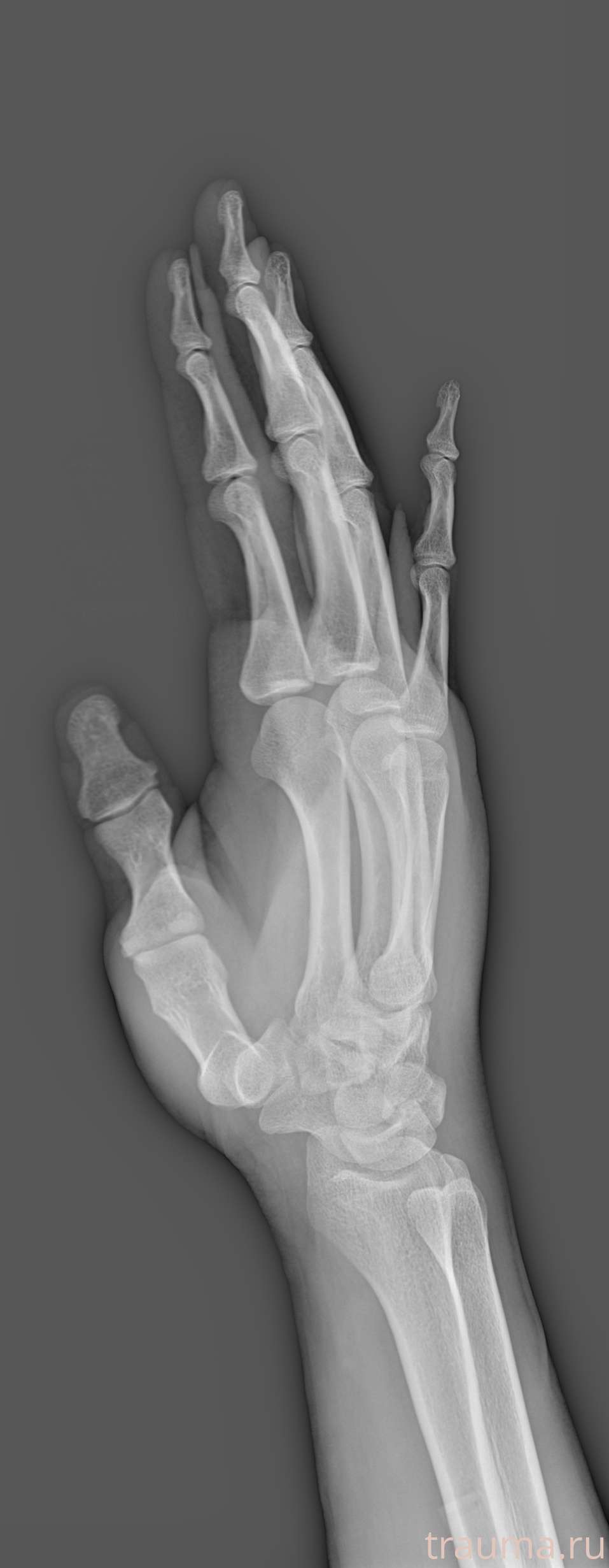 Рентген на дому: по вашему адресу приезжает врач-рентгенолог, травматолог-ортопед с мобильным рентгеновским аппаратом, проводит диагностику травмы или заболевания, делает необходимые рентгенограммы, дает рекомендации по дальнейшему лечению. Получить качественные снимки в домашних условиях возможно благодаря уникальной методике, разработанной МосРентген Центром для института  Склифосовского