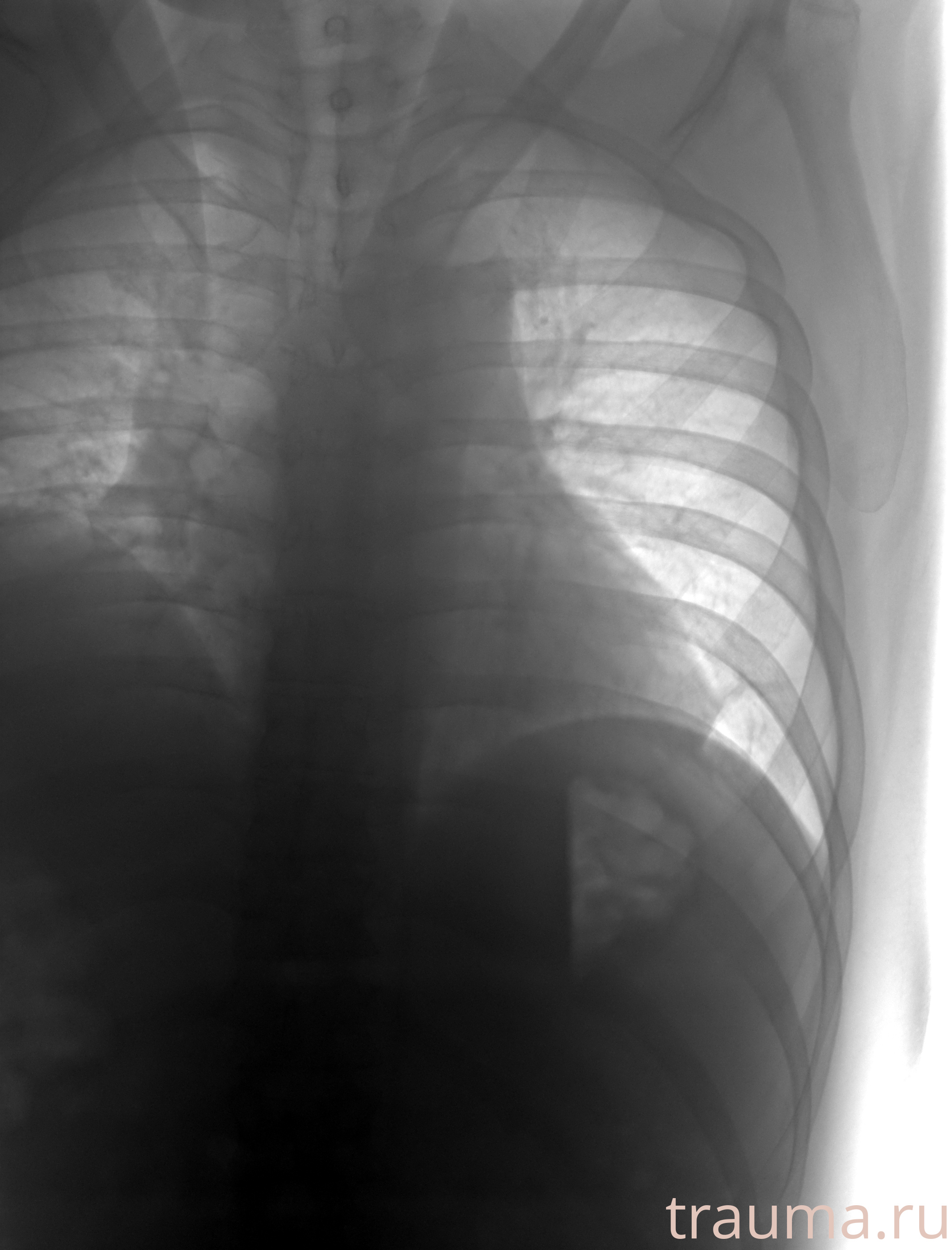 Рентген на дому: по вашему адресу приезжает врач-рентгенолог, травматолог-ортопед с мобильным рентгеновским аппаратом, проводит диагностику травмы или заболевания, делает необходимые рентгенограммы, дает рекомендации по дальнейшему лечению. Получить качественные снимки в домашних условиях возможно благодаря уникальной методике, разработанной МосРентген Центром для института  Склифосовского