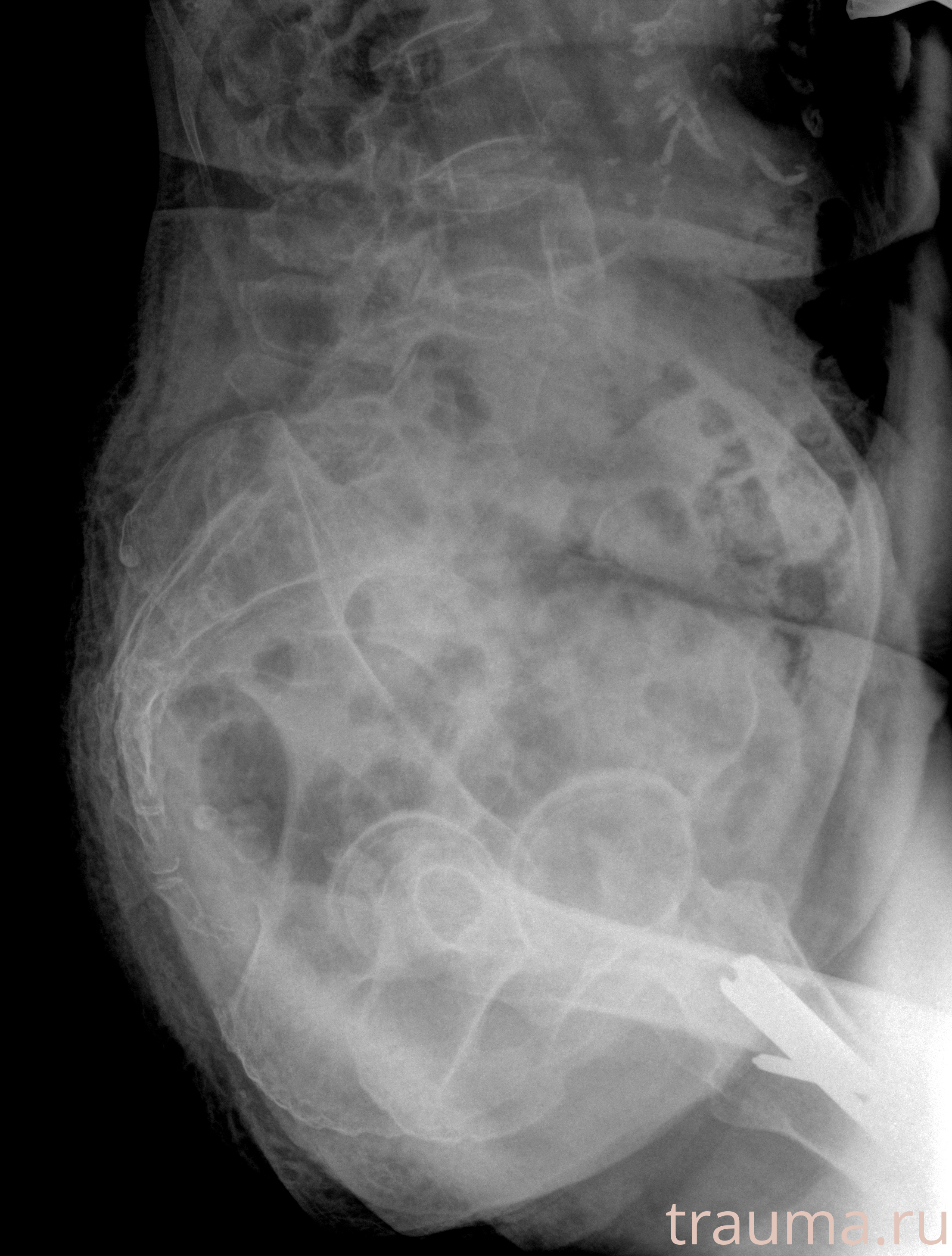 Рентген на дому: по вашему адресу приезжает врач-рентгенолог, травматолог-ортопед с мобильным рентгеновским аппаратом, проводит диагностику травмы или заболевания, делает необходимые рентгенограммы, дает рекомендации по дальнейшему лечению. Получить качественные снимки в домашних условиях возможно благодаря уникальной методике, разработанной МосРентген Центром для института  Склифосовского