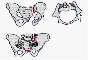 Подходы к диагностике и лечению переломов крестца. Систематизированный обзор Подходы к диагностике и лечению переломов крестца. Систематизированный обзор