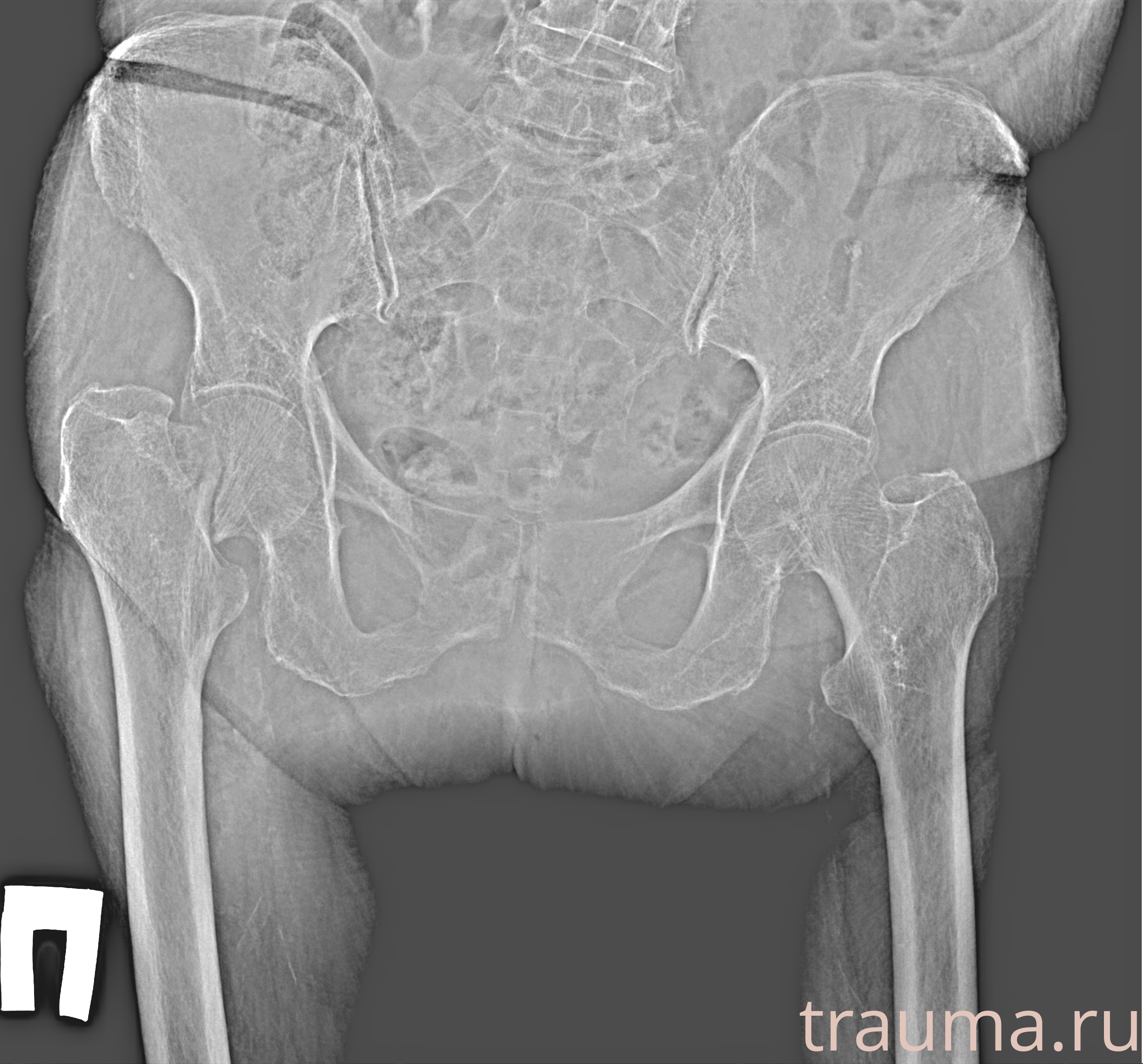 Рентген на дому: по вашему адресу приезжает врач-рентгенолог, травматолог-ортопед с мобильным рентгеновским аппаратом, проводит диагностику травмы или заболевания, делает необходимые рентгенограммы, дает рекомендации по дальнейшему лечению. Получить качественные снимки в домашних условиях возможно благодаря уникальной методике, разработанной МосРентген Центром для института  Склифосовского