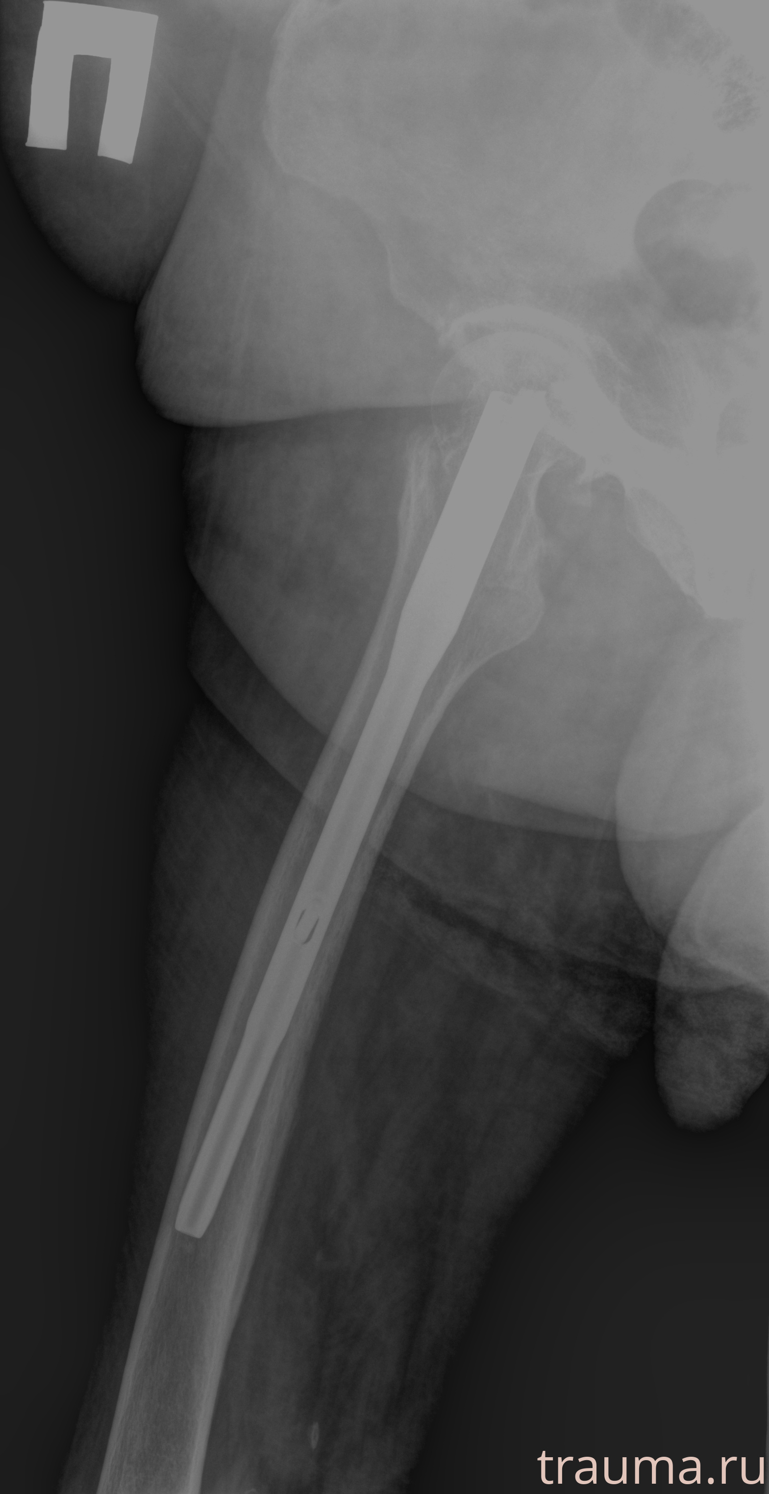 Рентген на дому: по вашему адресу приезжает врач-рентгенолог, травматолог-ортопед с мобильным рентгеновским аппаратом, проводит диагностику травмы или заболевания, делает необходимые рентгенограммы, дает рекомендации по дальнейшему лечению. Получить качественные снимки в домашних условиях возможно благодаря уникальной методике, разработанной МосРентген Центром для института  Склифосовского