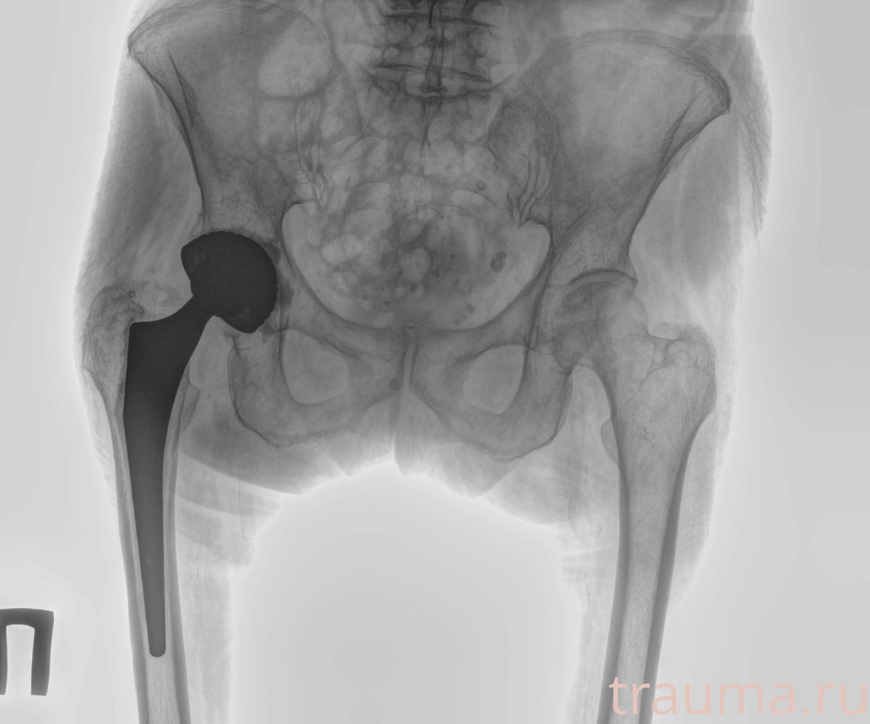 Рентген на дому: по вашему адресу приезжает врач-рентгенолог, травматолог-ортопед с мобильным рентгеновским аппаратом, проводит диагностику травмы или заболевания, делает необходимые рентгенограммы, дает рекомендации по дальнейшему лечению. Получить качественные снимки в домашних условиях возможно благодаря уникальной методике, разработанной МосРентген Центром для института  Склифосовского