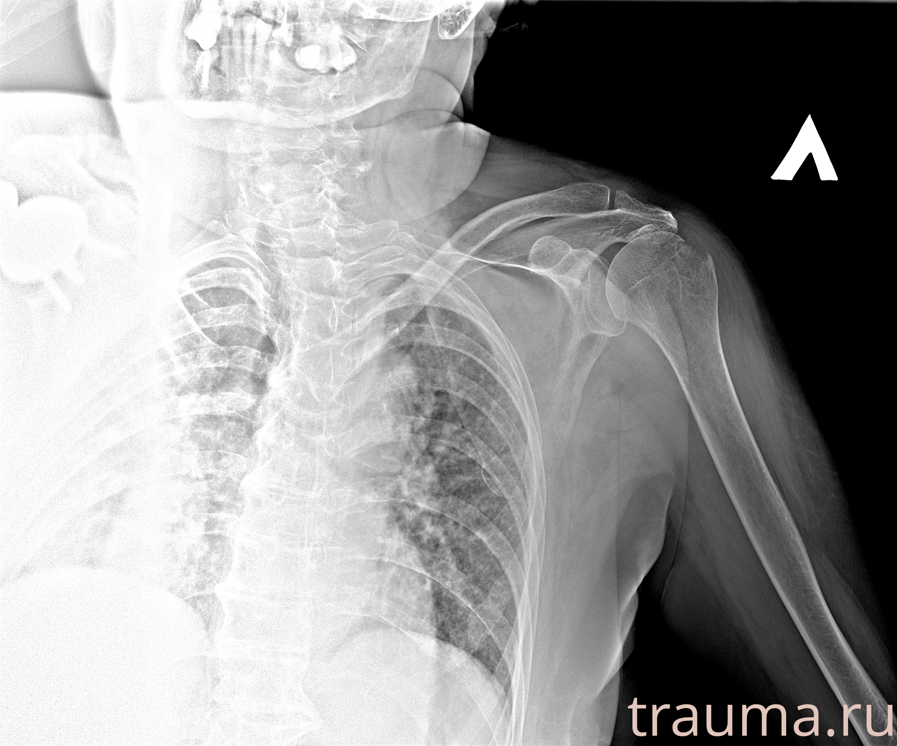 Рентген на дому: по вашему адресу приезжает врач-рентгенолог, травматолог-ортопед с мобильным рентгеновским аппаратом, проводит диагностику травмы или заболевания, делает необходимые рентгенограммы, дает рекомендации по дальнейшему лечению. Получить качественные снимки в домашних условиях возможно благодаря уникальной методике, разработанной МосРентген Центром для института  Склифосовского