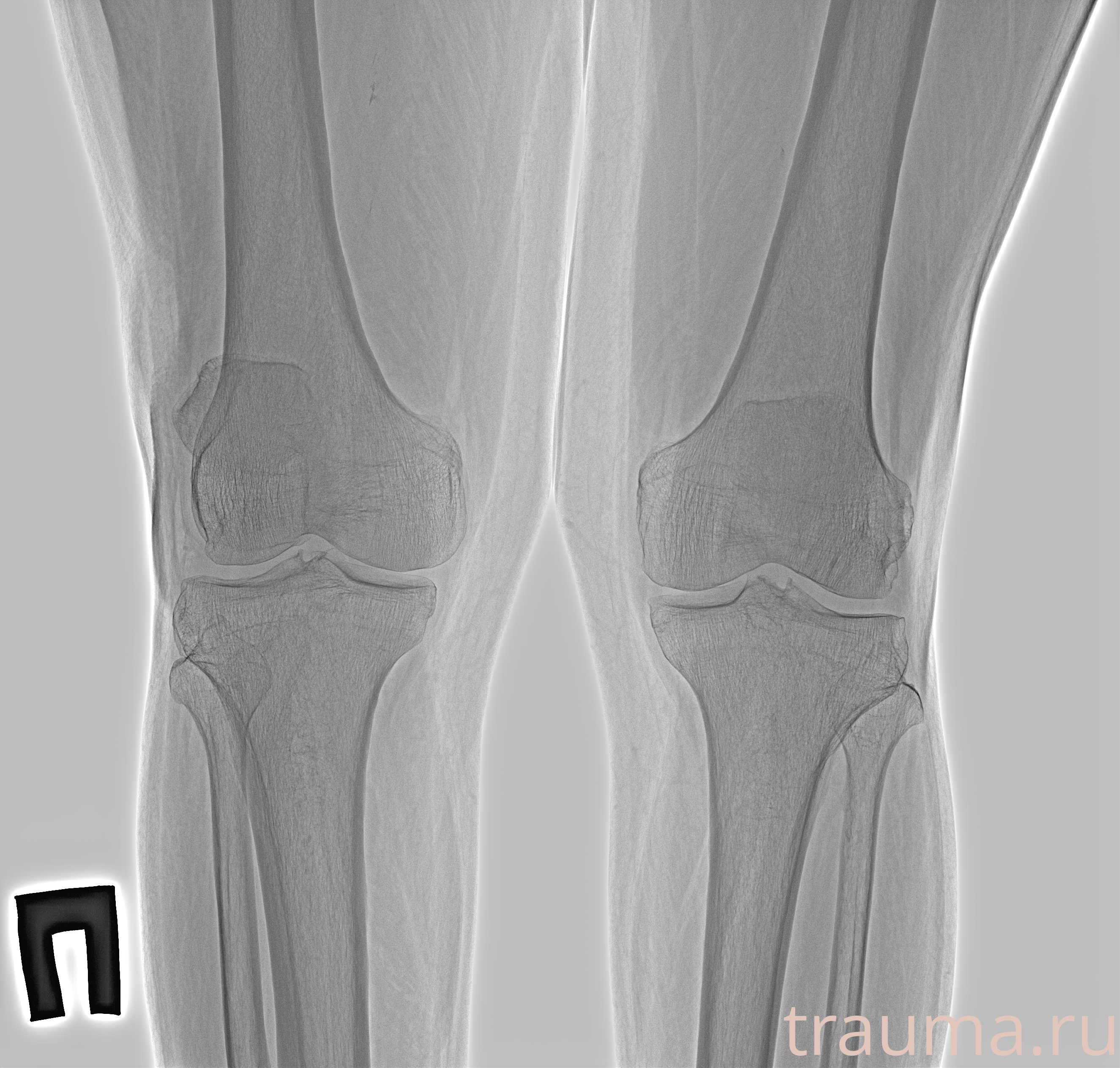 Рентген на дому: по вашему адресу приезжает врач-рентгенолог, травматолог-ортопед с мобильным рентгеновским аппаратом, проводит диагностику травмы или заболевания, делает необходимые рентгенограммы, дает рекомендации по дальнейшему лечению. Получить качественные снимки в домашних условиях возможно благодаря уникальной методике, разработанной МосРентген Центром для института  Склифосовского