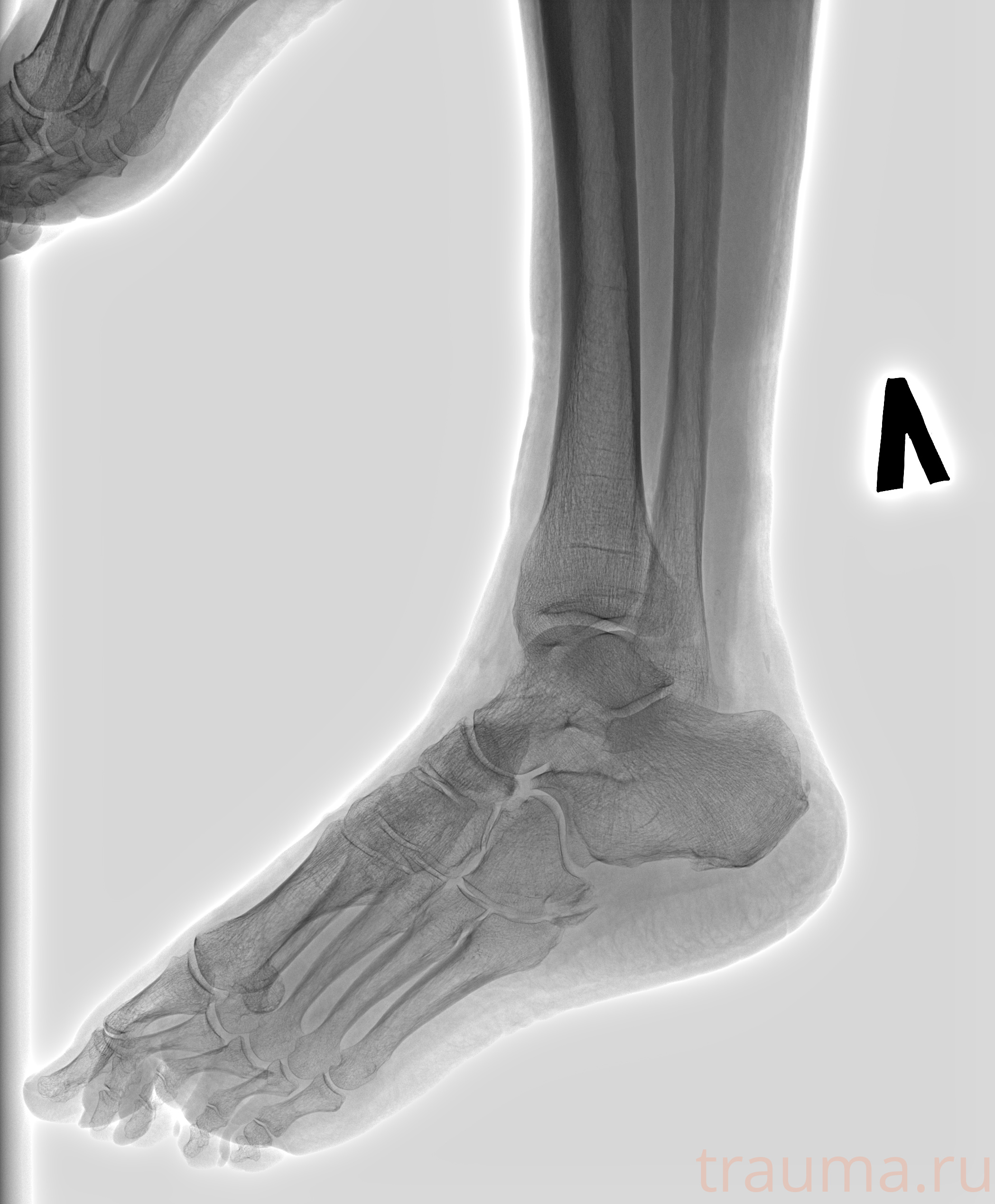 Рентген на дому: по вашему адресу приезжает врач-рентгенолог, травматолог-ортопед с мобильным рентгеновским аппаратом, проводит диагностику травмы или заболевания, делает необходимые рентгенограммы, дает рекомендации по дальнейшему лечению. Получить качественные снимки в домашних условиях возможно благодаря уникальной методике, разработанной МосРентген Центром для института  Склифосовского