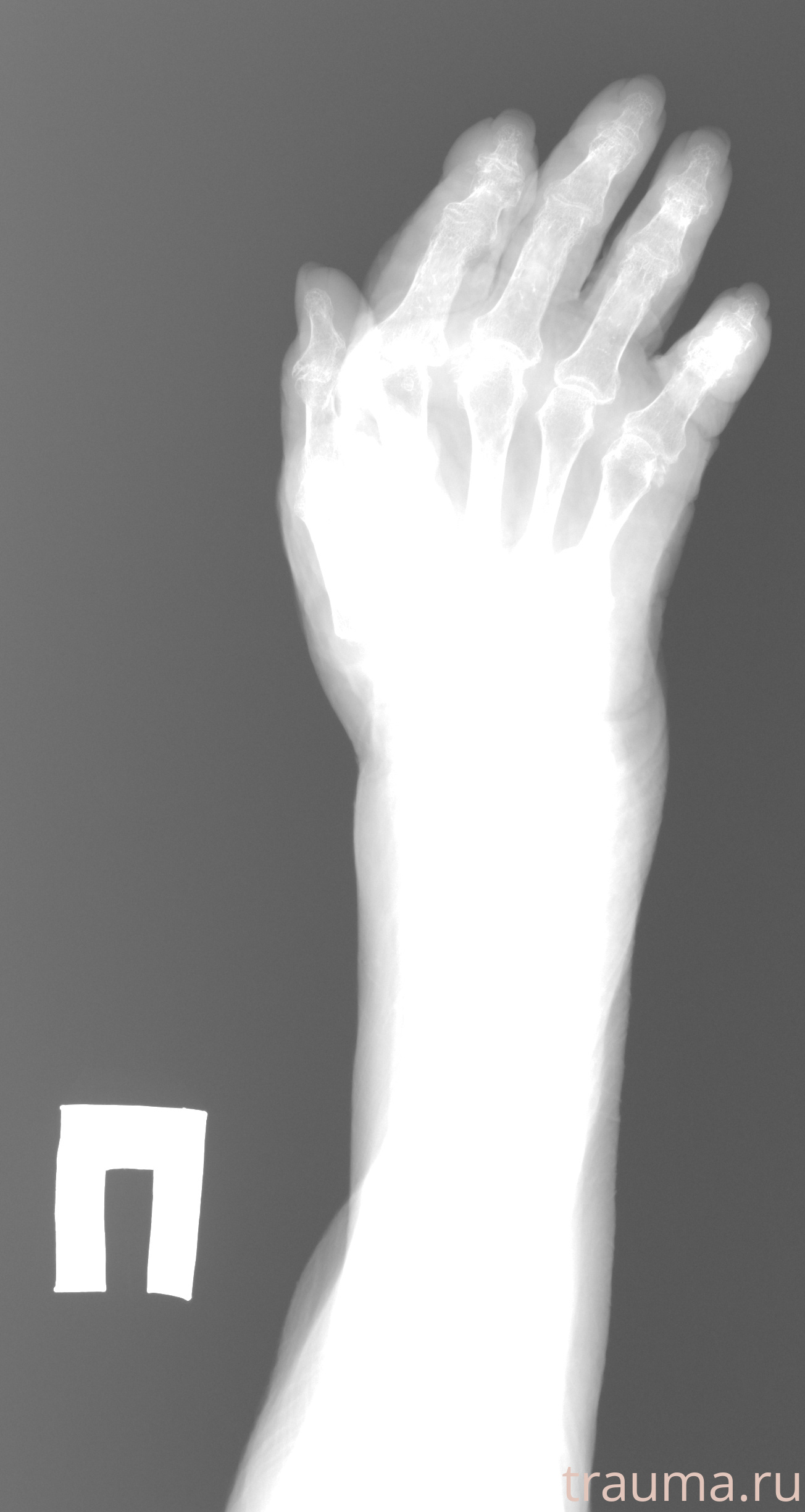 Рентген на дому: по вашему адресу приезжает врач-рентгенолог, травматолог-ортопед с мобильным рентгеновским аппаратом, проводит диагностику травмы или заболевания, делает необходимые рентгенограммы, дает рекомендации по дальнейшему лечению. Получить качественные снимки в домашних условиях возможно благодаря уникальной методике, разработанной МосРентген Центром для института  Склифосовского