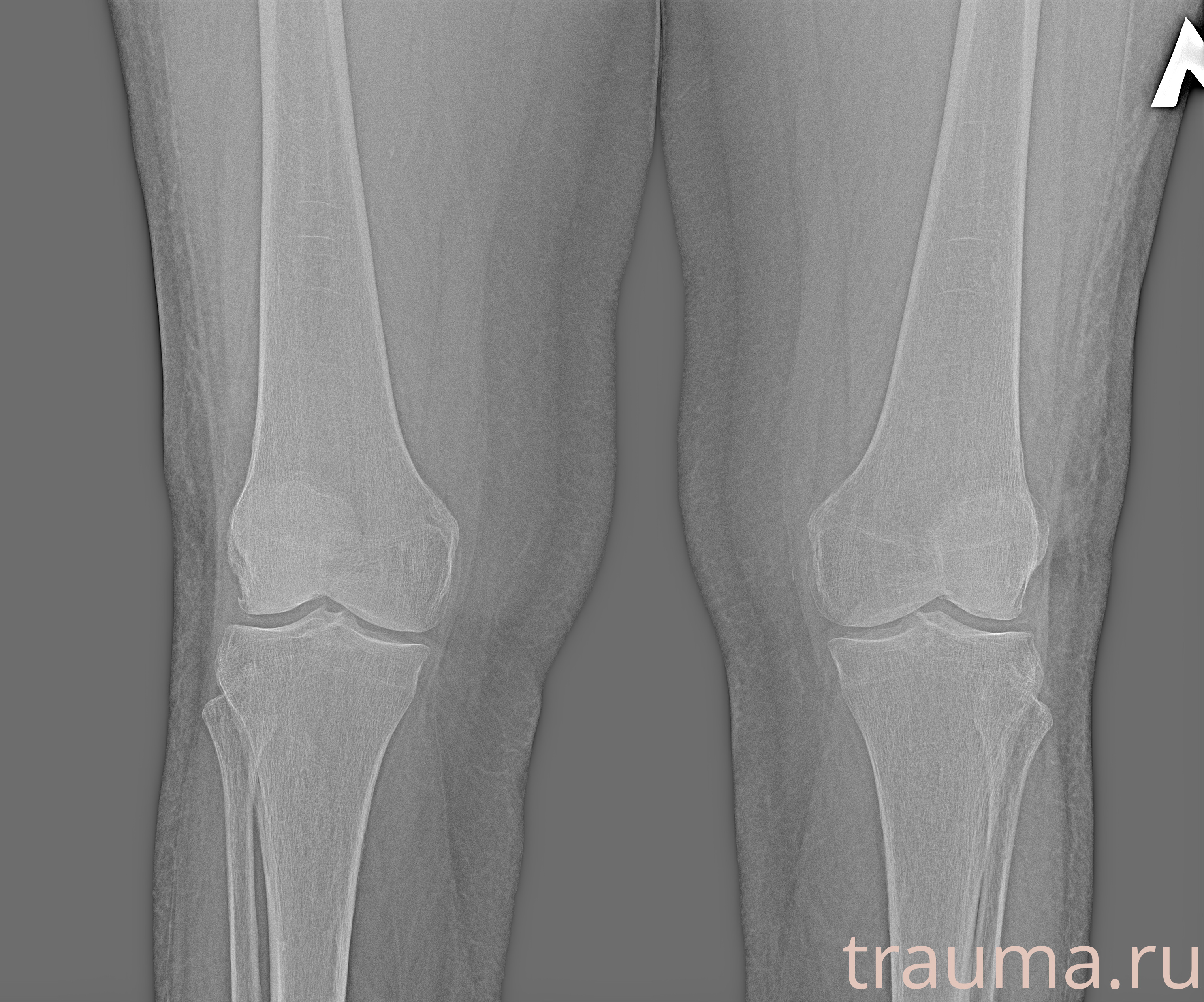 Рентген на дому: по вашему адресу приезжает врач-рентгенолог, травматолог-ортопед с мобильным рентгеновским аппаратом, проводит диагностику травмы или заболевания, делает необходимые рентгенограммы, дает рекомендации по дальнейшему лечению. Получить качественные снимки в домашних условиях возможно благодаря уникальной методике, разработанной МосРентген Центром для института  Склифосовского