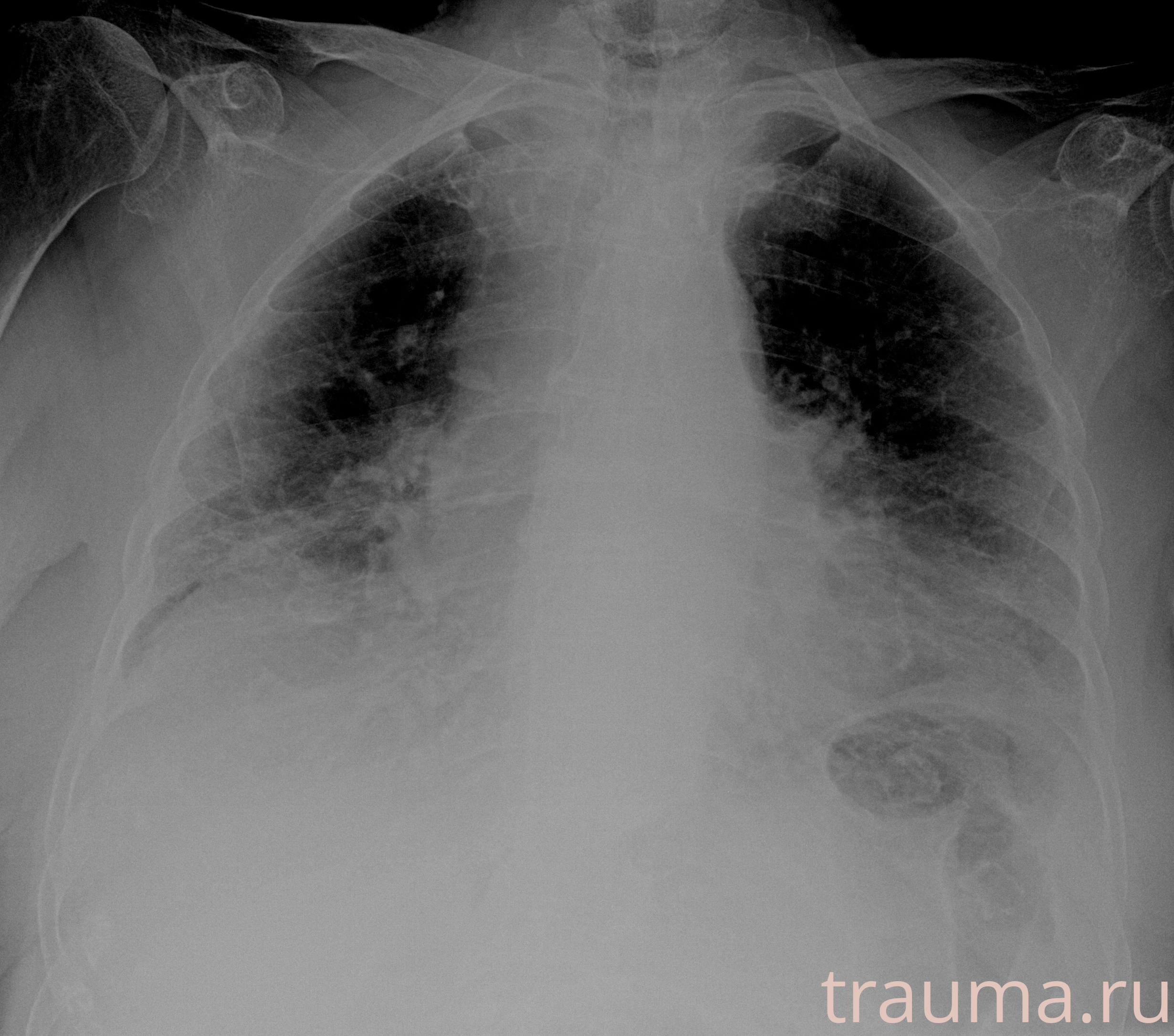 Рентген на дому: по вашему адресу приезжает врач-рентгенолог, травматолог-ортопед с мобильным рентгеновским аппаратом, проводит диагностику травмы или заболевания, делает необходимые рентгенограммы, дает рекомендации по дальнейшему лечению. Получить качественные снимки в домашних условиях возможно благодаря уникальной методике, разработанной МосРентген Центром для института  Склифосовского