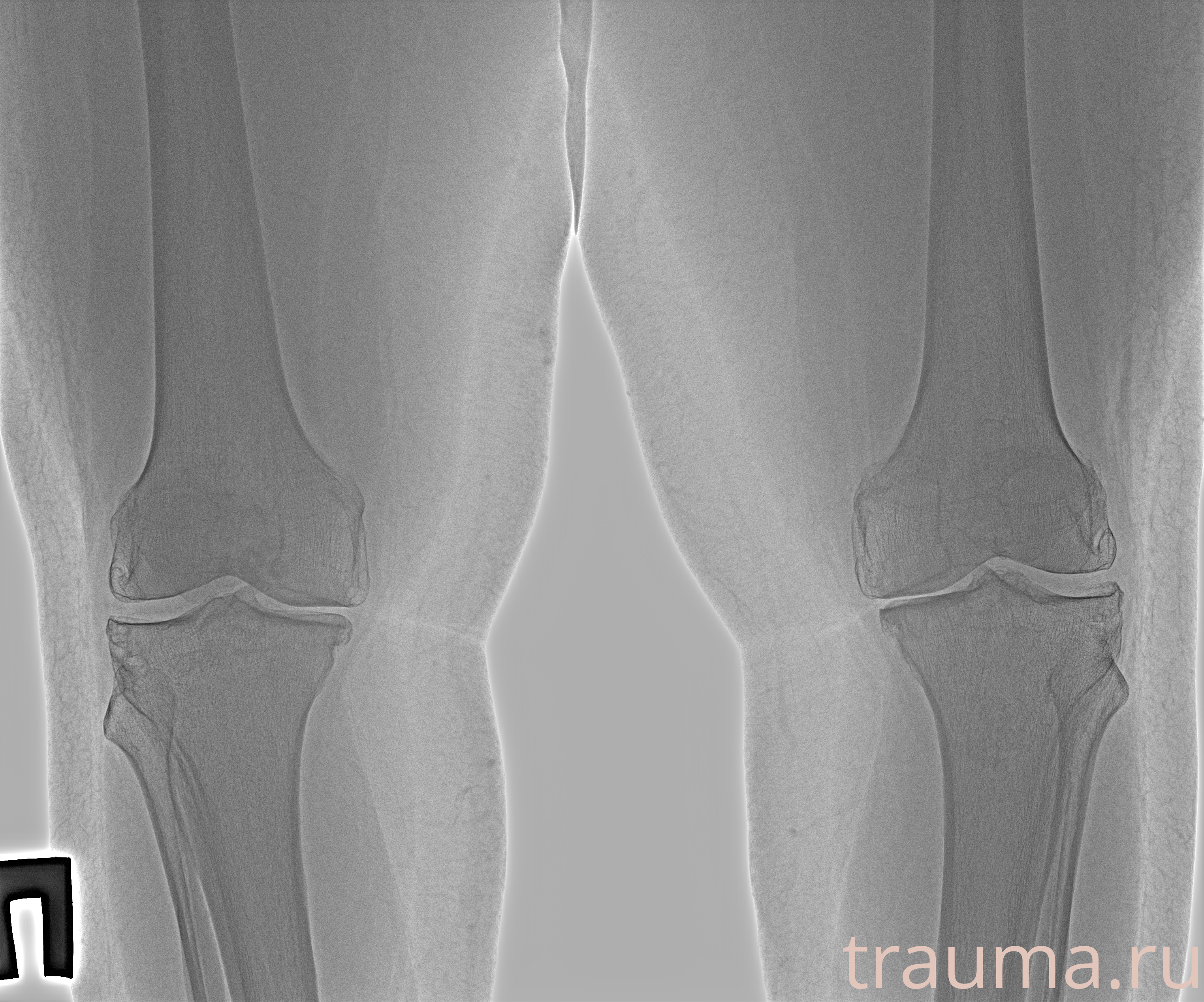 Рентген на дому: по вашему адресу приезжает врач-рентгенолог, травматолог-ортопед с мобильным рентгеновским аппаратом, проводит диагностику травмы или заболевания, делает необходимые рентгенограммы, дает рекомендации по дальнейшему лечению. Получить качественные снимки в домашних условиях возможно благодаря уникальной методике, разработанной МосРентген Центром для института  Склифосовского