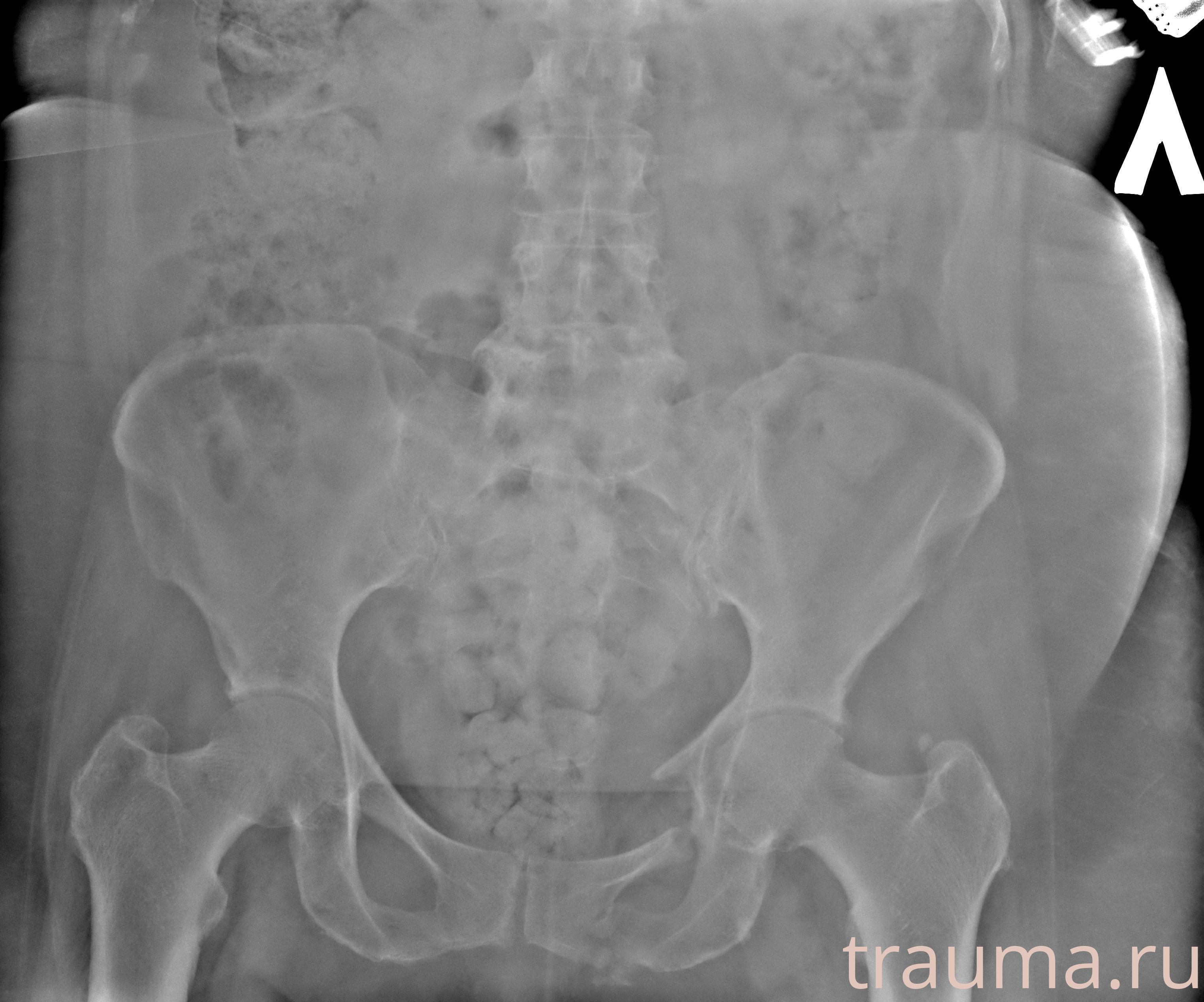 Рентген на дому: по вашему адресу приезжает врач-рентгенолог, травматолог-ортопед с мобильным рентгеновским аппаратом, проводит диагностику травмы или заболевания, делает необходимые рентгенограммы, дает рекомендации по дальнейшему лечению. Получить качественные снимки в домашних условиях возможно благодаря уникальной методике, разработанной МосРентген Центром для института  Склифосовского