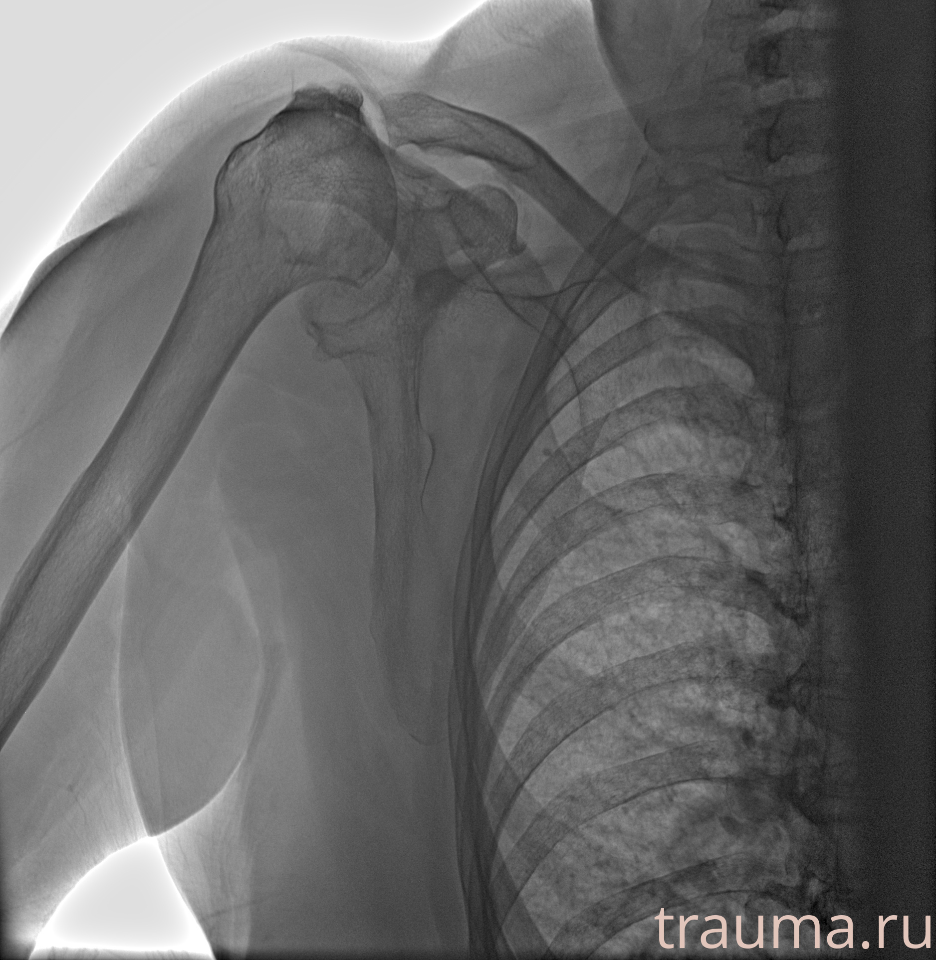 Рентген на дому: по вашему адресу приезжает врач-рентгенолог, травматолог-ортопед с мобильным рентгеновским аппаратом, проводит диагностику травмы или заболевания, делает необходимые рентгенограммы, дает рекомендации по дальнейшему лечению. Получить качественные снимки в домашних условиях возможно благодаря уникальной методике, разработанной МосРентген Центром для института  Склифосовского